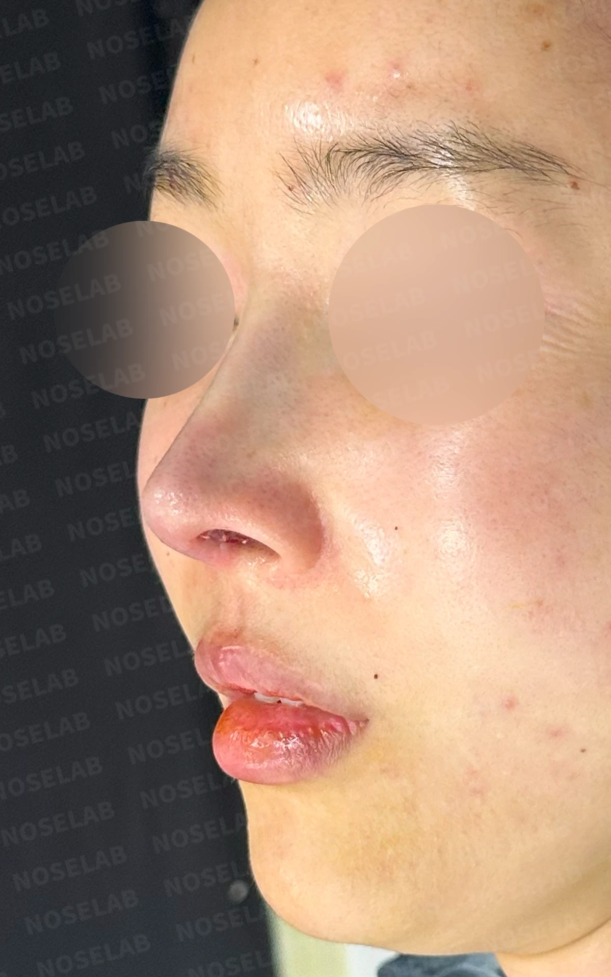 코가 들리고 콧기둥이 꺼지며 코끝이 찝혀 보이는 이유, 복합 교정은 어떻게 하나 — 수술 전 / 수술 직후 0일 직후 사진은 부기가 있는 상태로 최종 결과와 다를 수 있습니다.