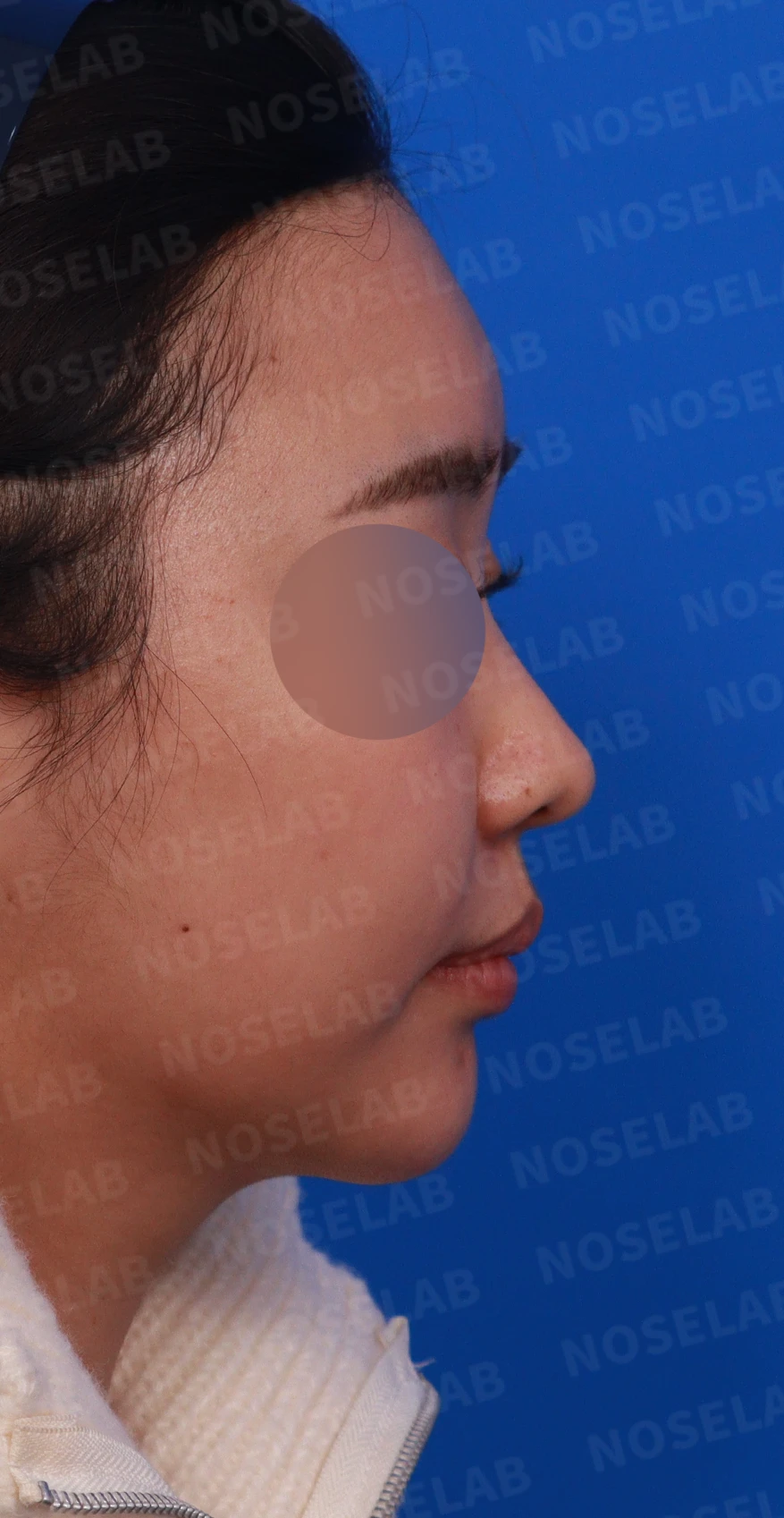 비염 수술을 받았는데도 코막힘이 돌아오는 이유, 구조 교정은 어떻게 하나 — 디자인 상담 우측 측면, 비스듬한 측면, 비공 사진