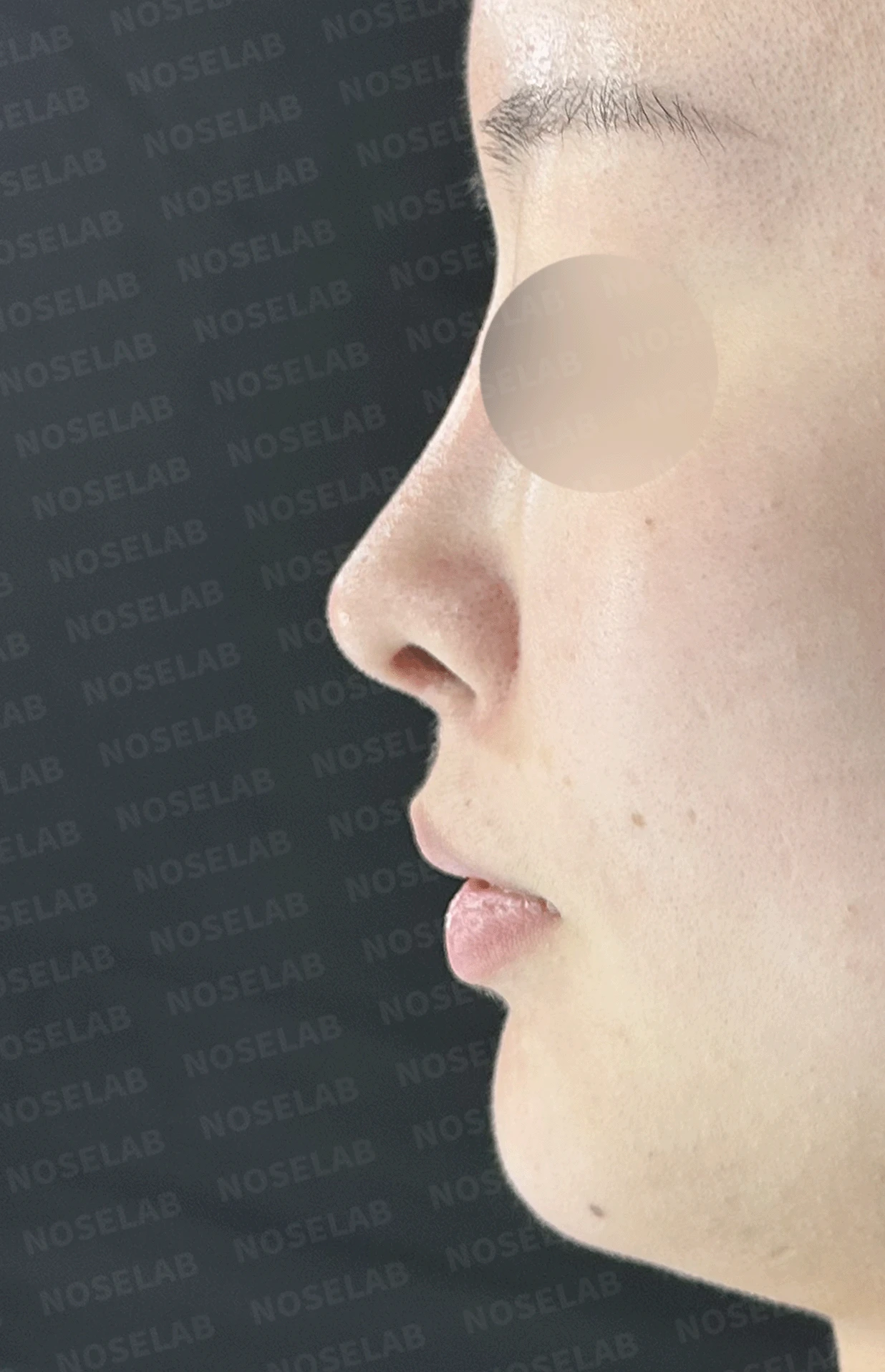 콧대가 인위적으로 보이고 코가 들리는 이유, 재건은 어떻게 하나 — 본문 사진 9