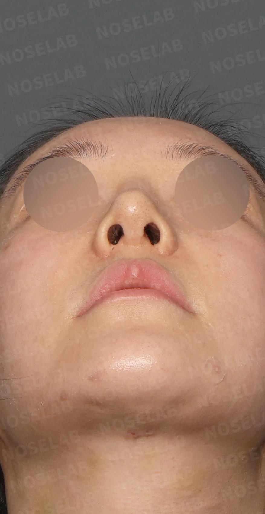 뭉툭하고 처진 긴코, 비개방 코재수술로 여성스러운 직반라인 완성 — 디자인 상담 우측 측면, 비스듬한 측면, 비공 사진입니다.