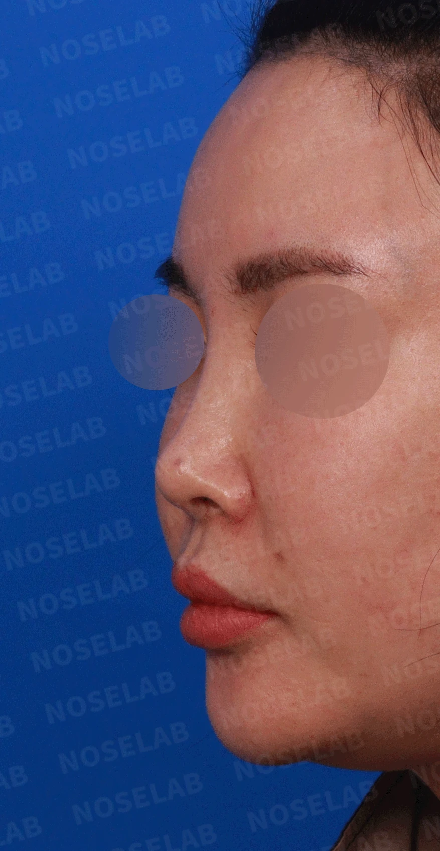 제거했다던 주사 이물질이 남는 이유와 들린 코끝 교정 방법 — 디자인 상담 정면, 좌측 , 비스듬한 측면 , 측면 사진입니다.