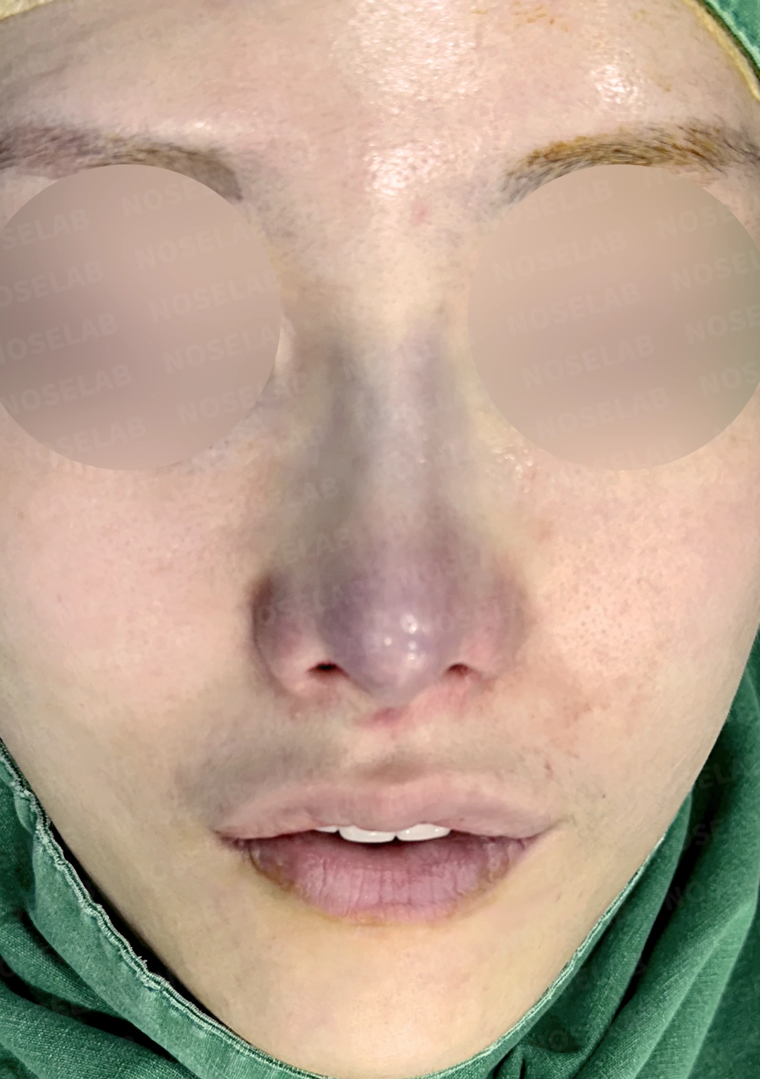 보형물 비침과 비대칭, 자가늑연골 코재수술로 자연스럽게 교정한 사례 — 직후 정면, 비스듬한 측면, 측면 사진