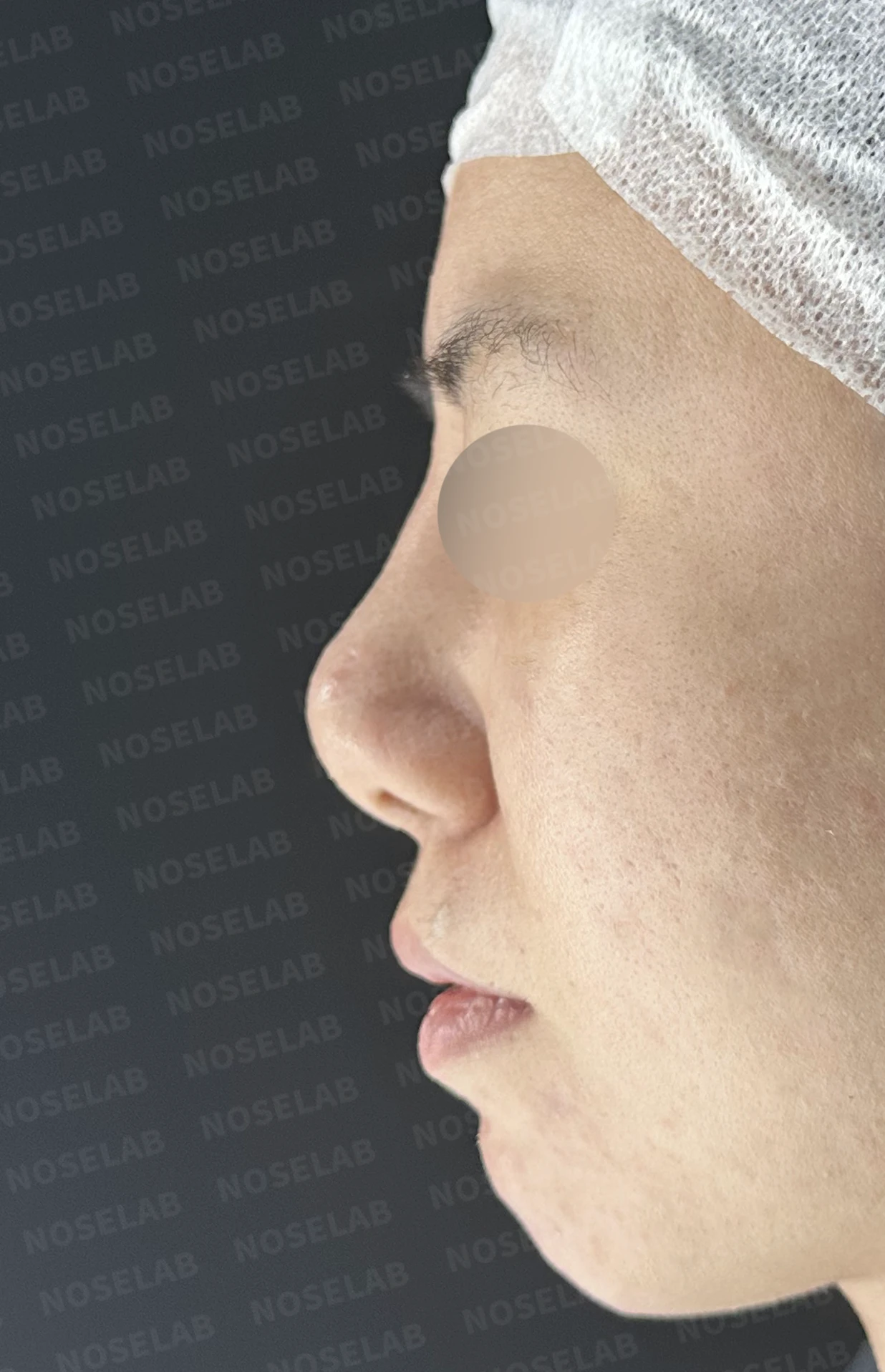 이전 수술 뒤 코가 딱딱해지고 짧아지는 구축, 왜 생기고 어떻게 재건하나 — 수술 전 / 수술 직후 0일 직후 사진은 부기가 있는 상태로 최종 결과와 다를 수 있습니다.