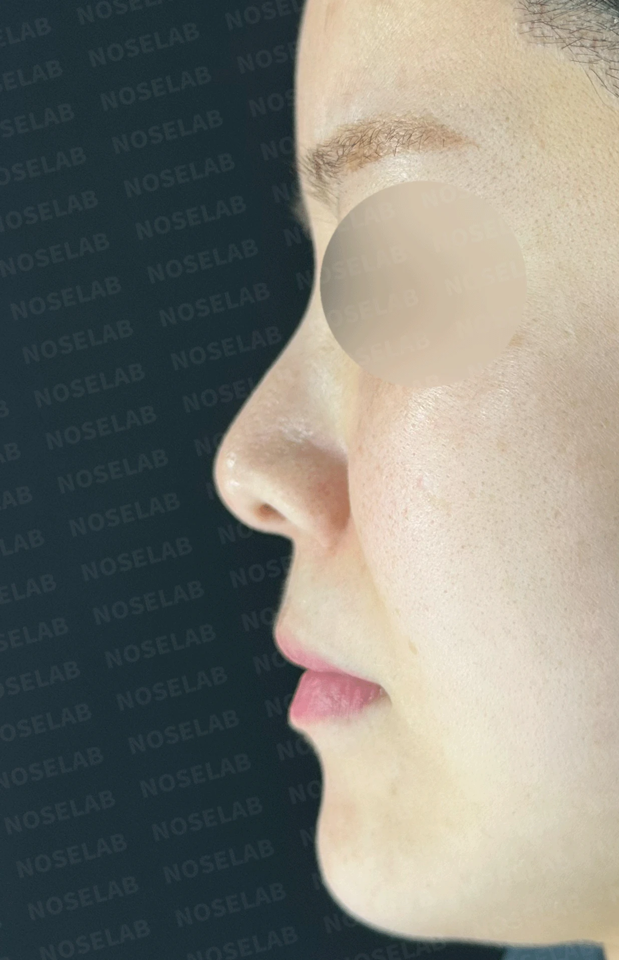 늑연골 석회화를 미리 확인해야 하는 이유와 휜코·짧은코 교정 방법 — 본문 사진 9