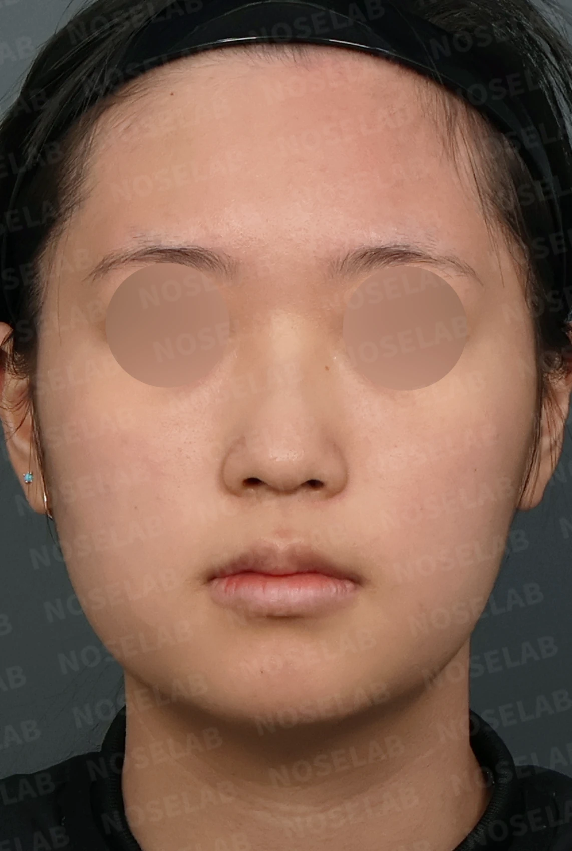 작은 콧날개 연골과 처진 코끝, 자가늑연골과 외측절골술로 자연스럽게 교정 — 디자인 상담 정면, 좌측 측면, 비스듬한 측면 사진입니다.
