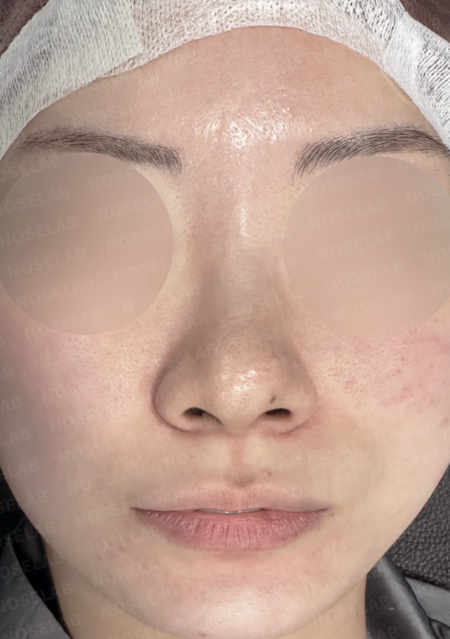 코끝이 퍼져 보이는 이유와 코바닥·비순각을 함께 다루는 방법 — 수술 전 / 수술 직후 0일 직후 사진은 부기가 있는 상태로 최종 결과와 다를 수 있습니다.