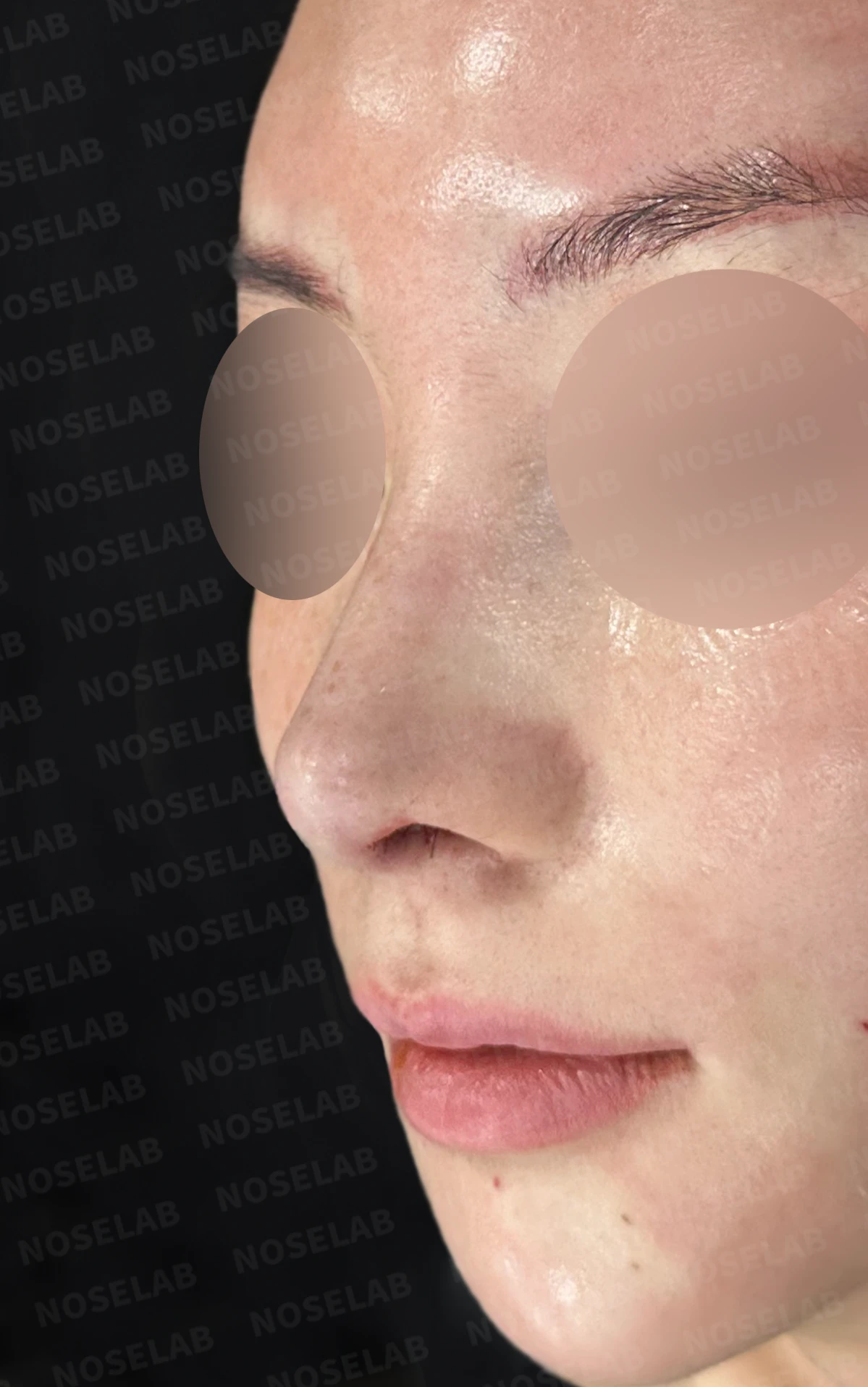 자가 늑연골 코재수술, 콧대부터 코끝까지 슬림하고 여성스럽게 — 직후 정면, 비스듬한 측면, 측면 사진 입니다.