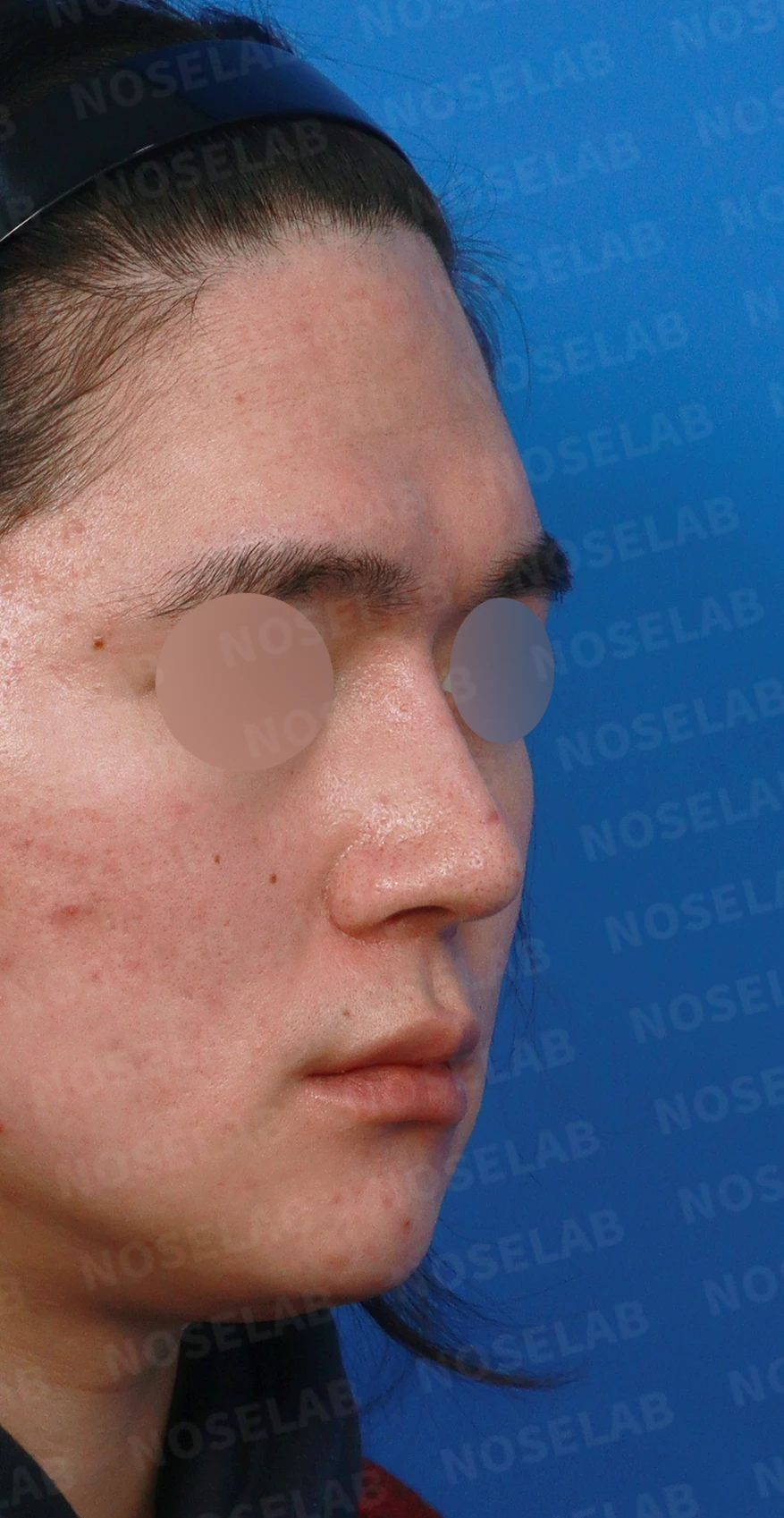 콧대를 더 높이고 싶을 때 무엇이 한계를 만드나, 3D 맞춤 보형물과 자가늑연골 코끝 지지 — 디자인 상담 우측 측면, 비스듬한 측면, 비공 사진입니다.