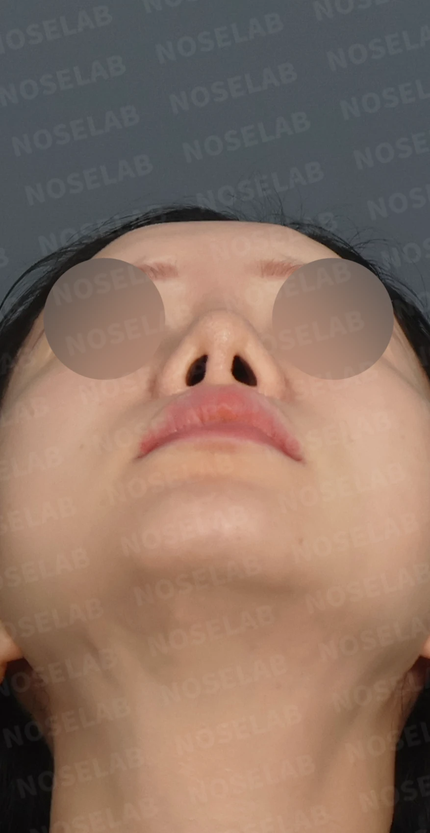 짧은 코와 복코, 자가늑연골로 세련되게 교정한 코재수술 — 디자인 상담 우측 측면, 비스듬한 측면, 비공 사진입니다.