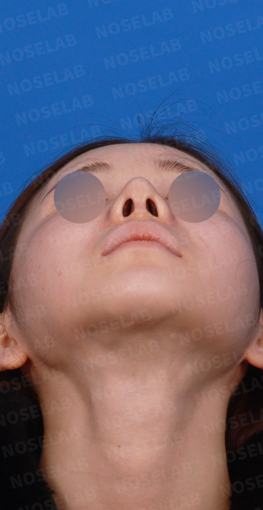 코성형 뒤 코끝이 들리고 비주가 짧아 보이는 이유, 비주 하강과 콧대 라인 교정 방법 — 디자인 상담 우측 측면, 비스듬한 측면, 비공 사진입니다.