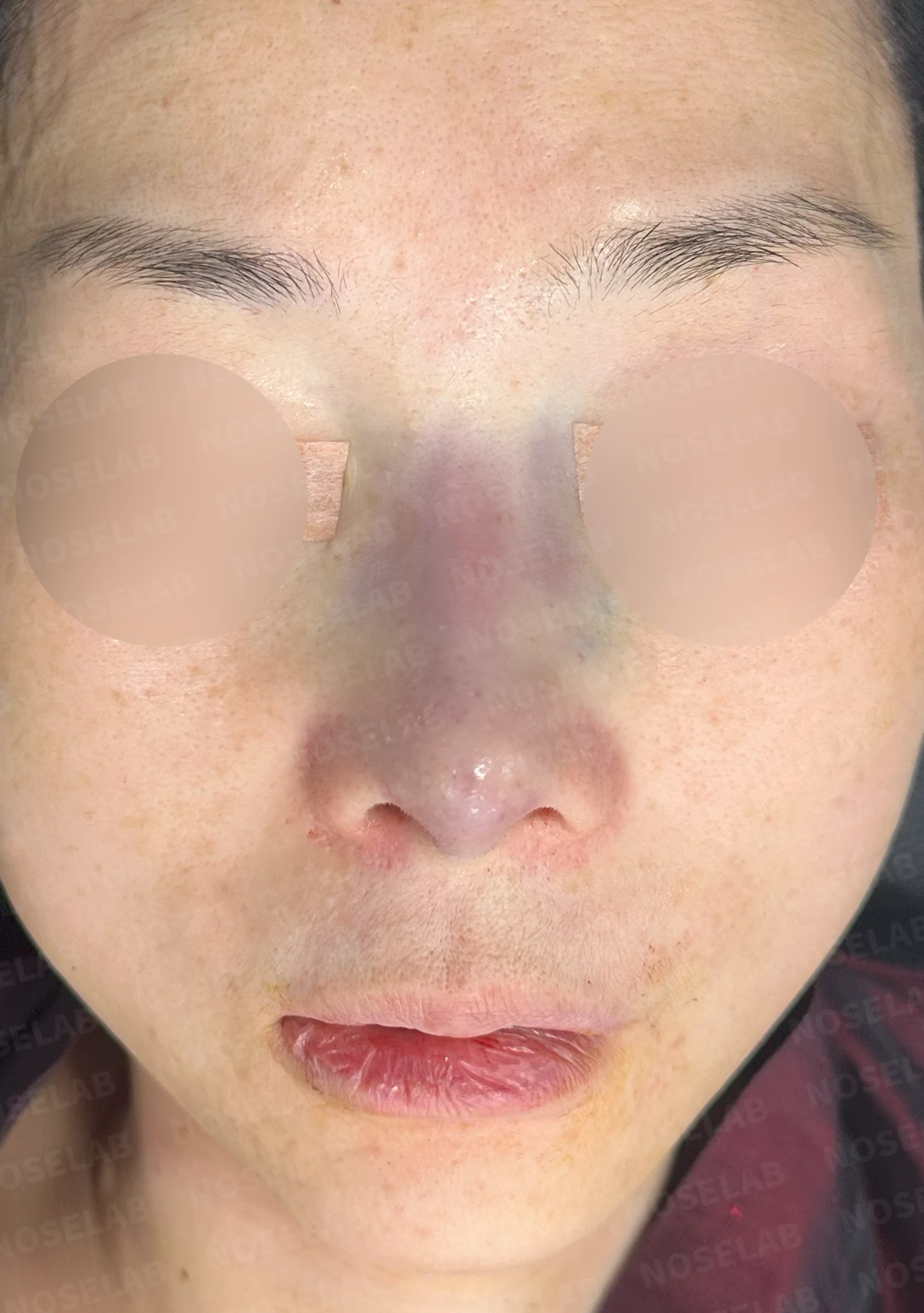 오래된 실리콘 피막이 석회화되면 왜 매부리와 휜 코가 생기나 — 본문 사진 8