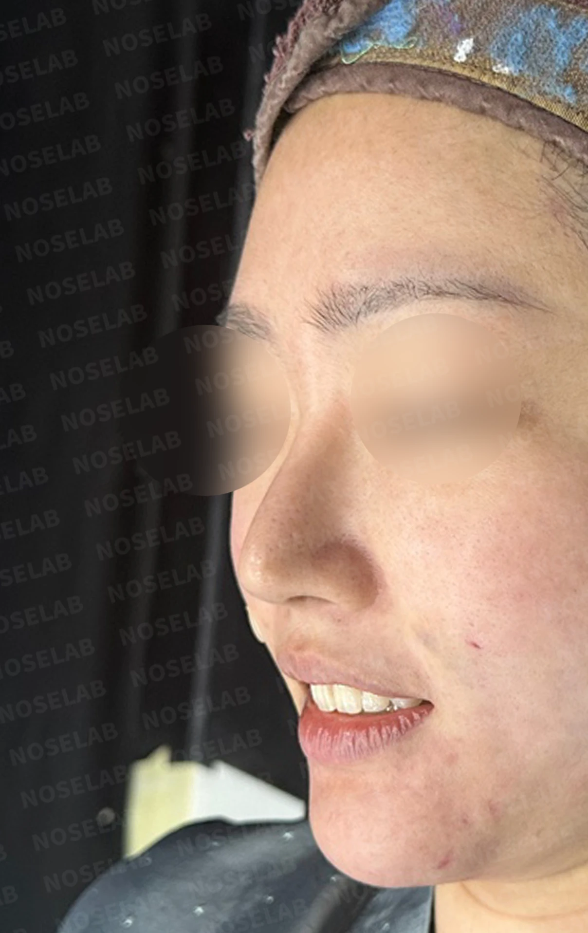 재수술한 코가 휘어 보이고 코끝이 처지는 이유 — 수술 전 / 수술 직후 0일 직후 사진은 부기가 있는 상태로 최종 결과와 다를 수 있습니다.