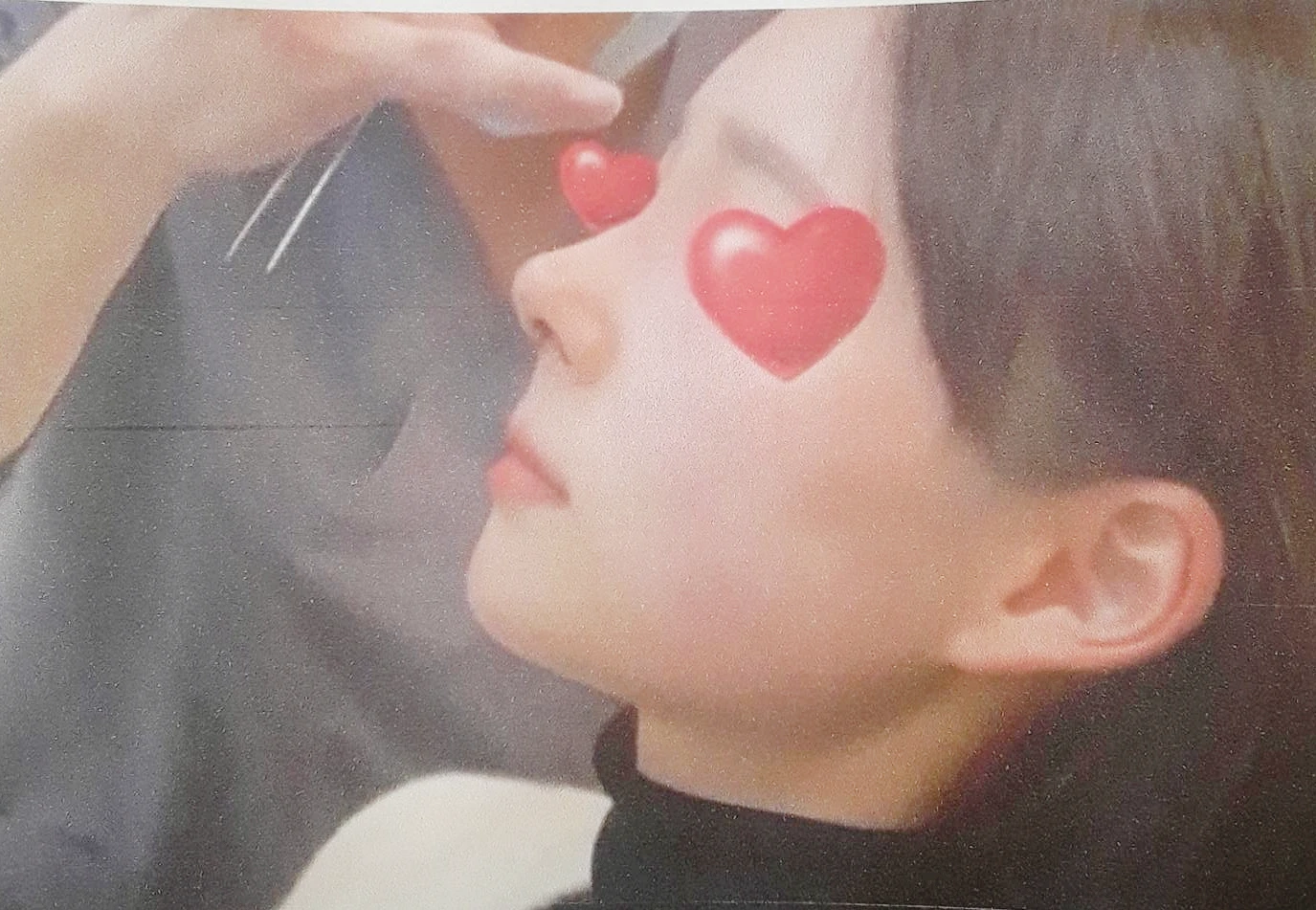 코끝 처짐과 코막힘을 함께 살펴보는 재수술 방법 — 환자분이 원하시는 사진들입니다.