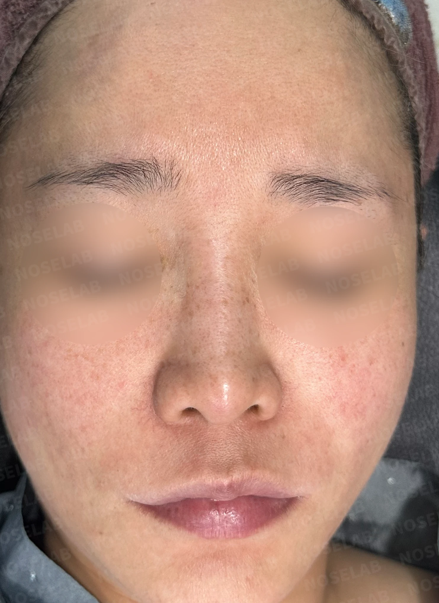 코에 주입된 칼슘필러의 제거와 재건 방법 — 수술 전 / 수술 직후 0일 직후 사진은 부기가 있는 상태로 최종 결과와 다를 수 있습니다.