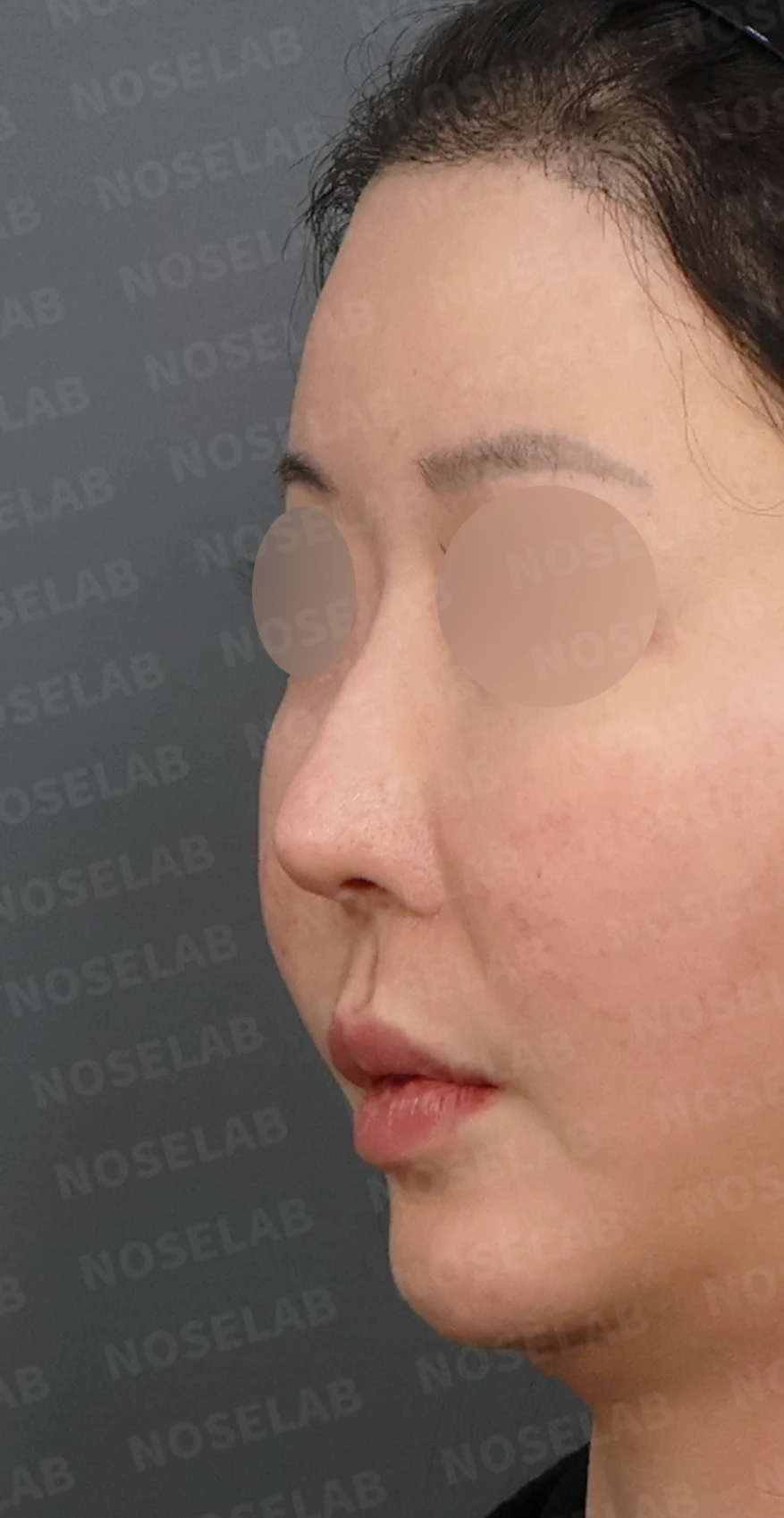 코성형 뒤 코막힘이 더 심해지는 이유, 비중격 재건과 절골 복원은 어떻게 하나 — 디자인 상담 정면, 좌측 측면, 비스듬한 측면 사진입니다.