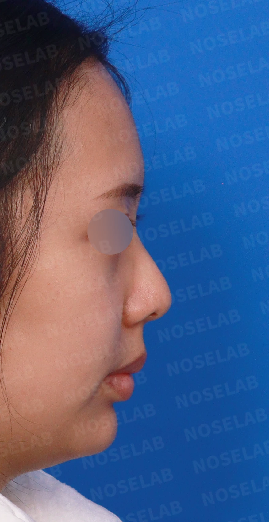 휘어진 매부리와 처진 코끝이 생기는 이유, 비중격 연장술은 어떻게 하나 — 디자인 상담 우측 측면, 비스듬한 측면, 비공 사진입니다.
