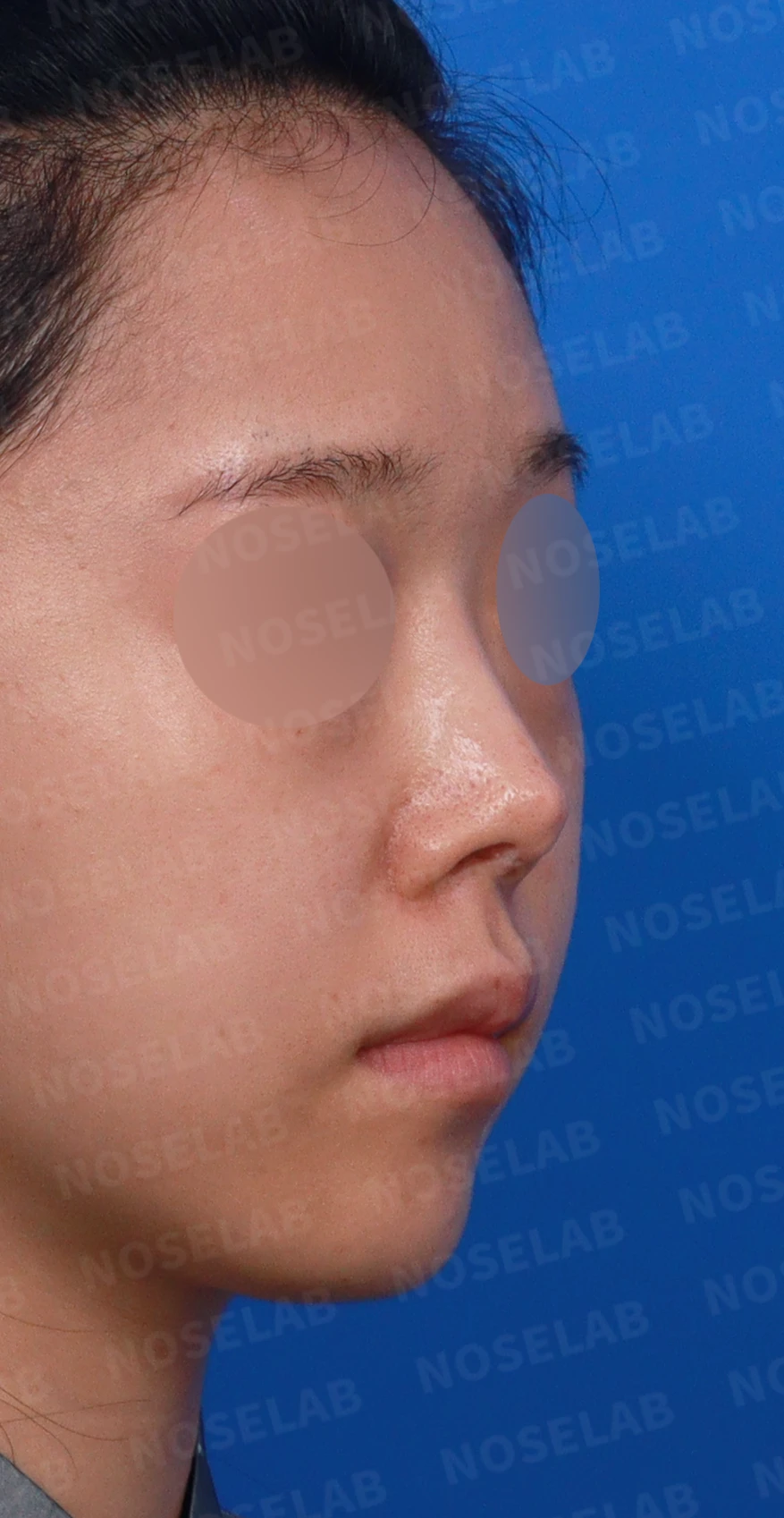 코끝 피부가 얇아져 연골이 비치는 이유, 피부 보강은 어떻게 하나 — 디자인 상담 우측 측면, 비스듬한 측면, 비공 사진입니다.