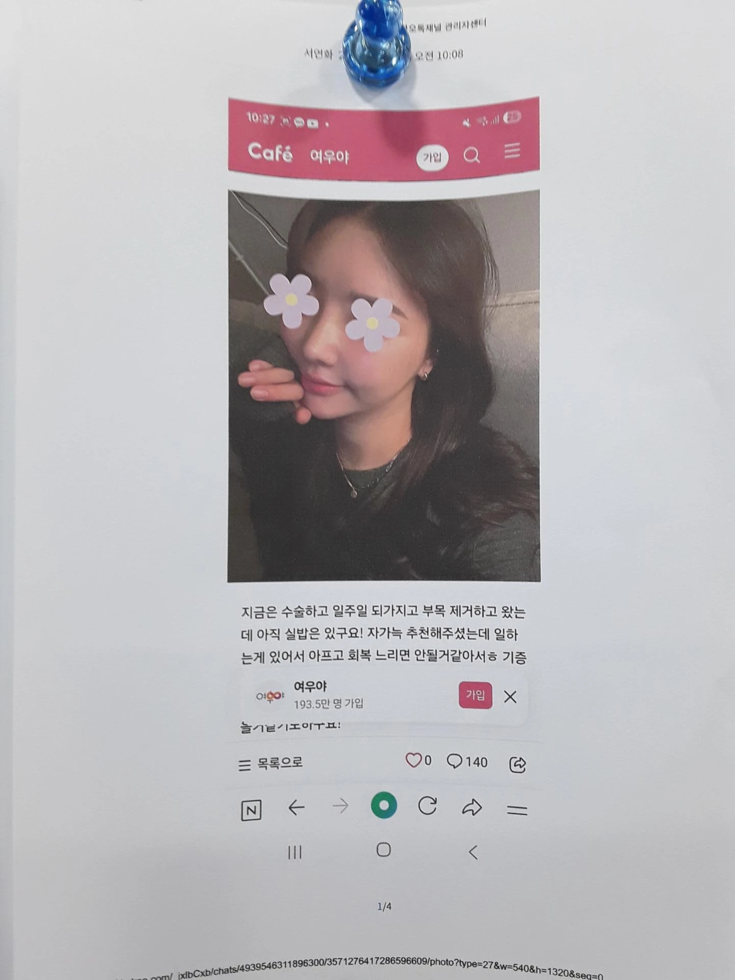 코 수술 뒤 염증이 오래 지속되면 생기는 변화와 재건 방법 — 환자분 요구사항 사진들