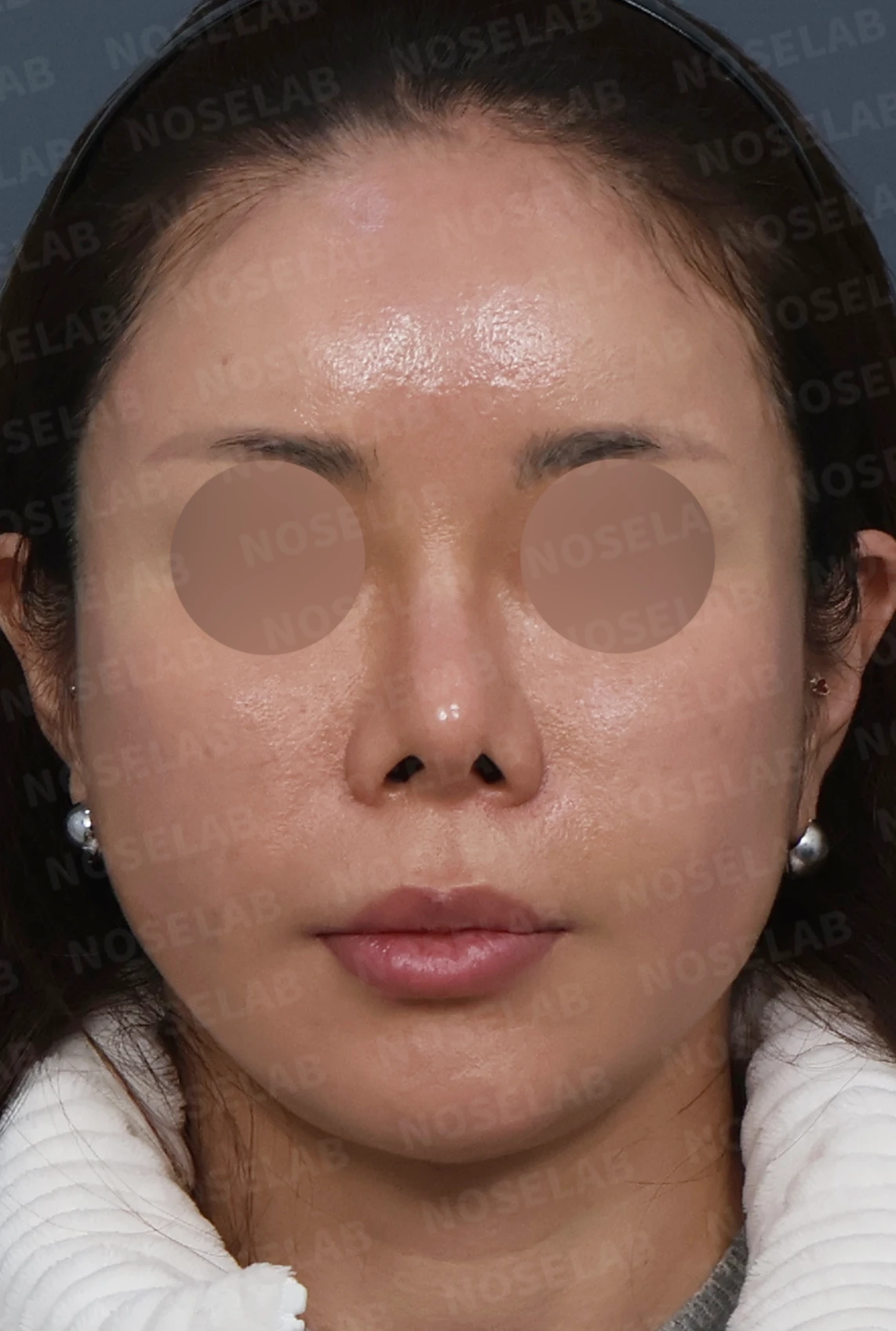 비중격 소실 후 들린 코끝과 찝혀 보이는 콧날개, 자가늑연골로 정밀 재건 — 디자인 상담 정면, 좌측 측면, 비스듬한 측면 사진입니다.