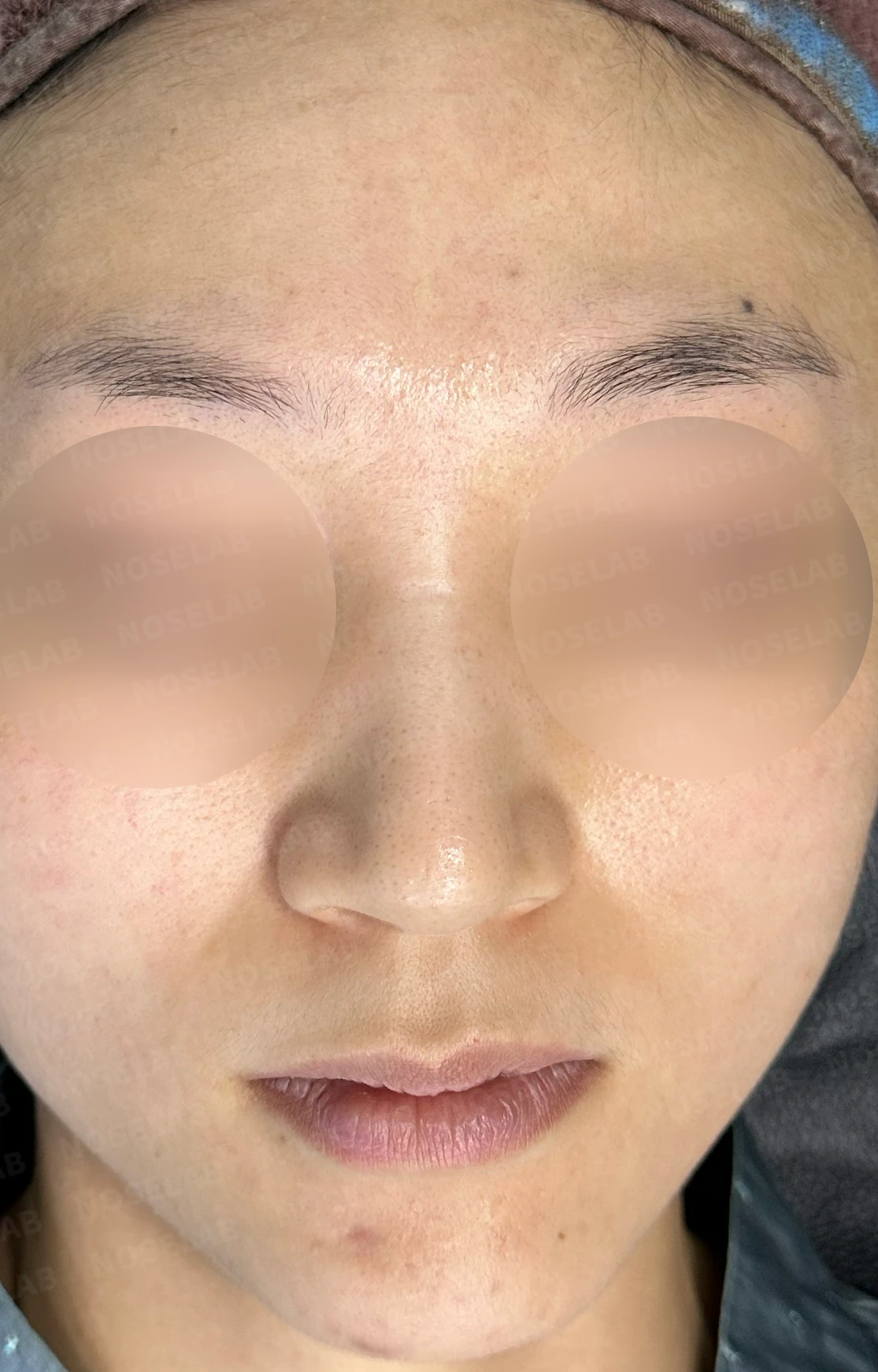 뭉툭한 처진코 교정 방법 — 수술 전 / 수술 직후 0일 직후 사진은 부기가 있는 상태로 최종 결과와 다를 수 있습니다.