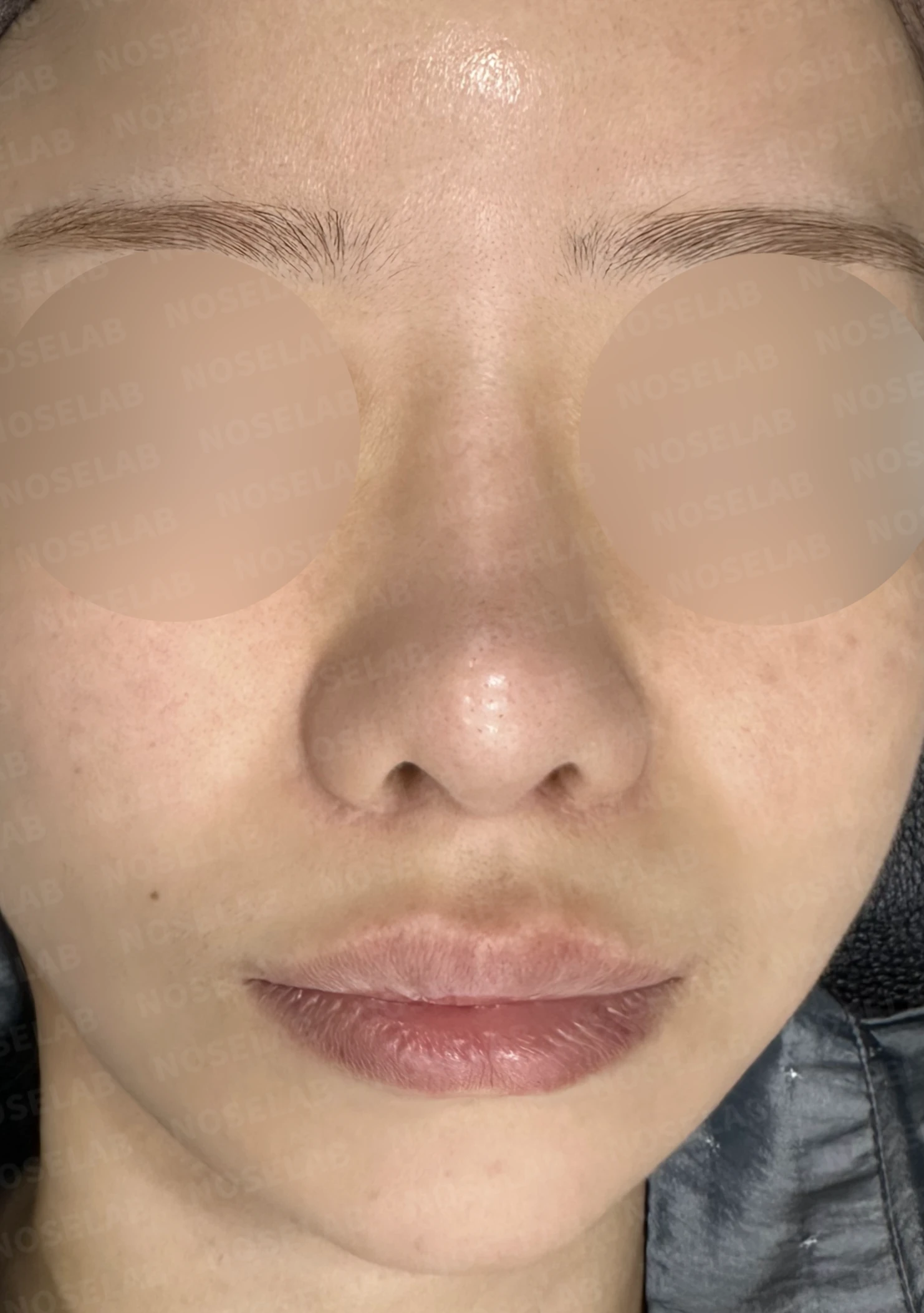여러 차례 수술 뒤에도 코막힘과 휜 코가 남는 이유 — 수술 전 / 수술 직후 0일 직후 사진은 부기가 있는 상태로 최종 결과와 다를 수 있습니다.