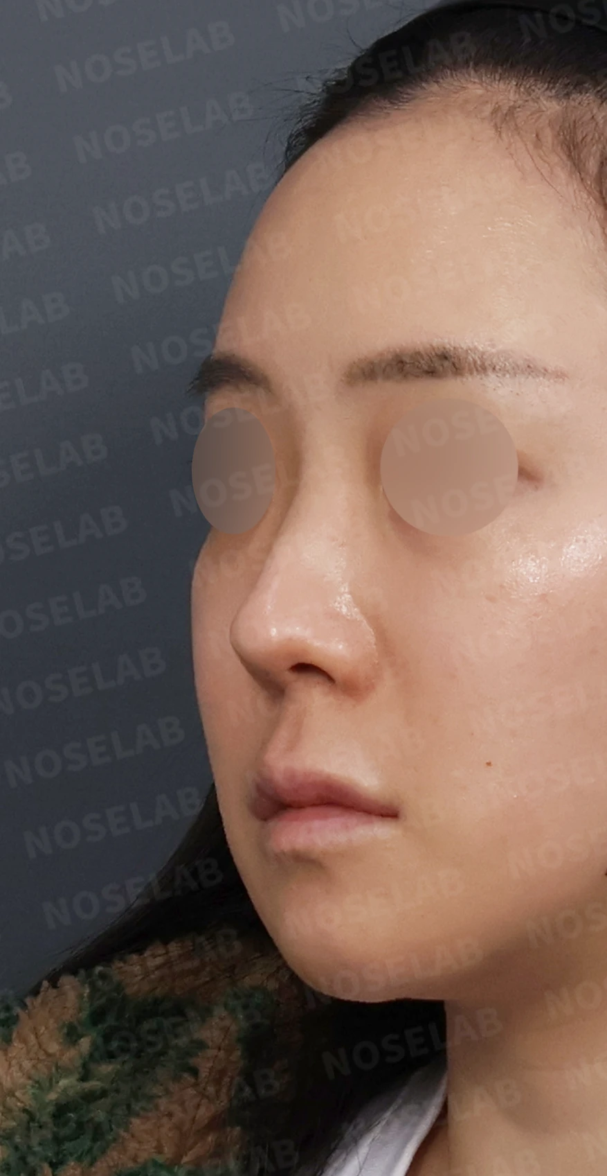 들린코 교정과 코막힘 개선, 자가늑연골로 코재수술 후기 — 디자인 상담 정면, 좌측 측면, 비스듬한 측면 사진입니다.