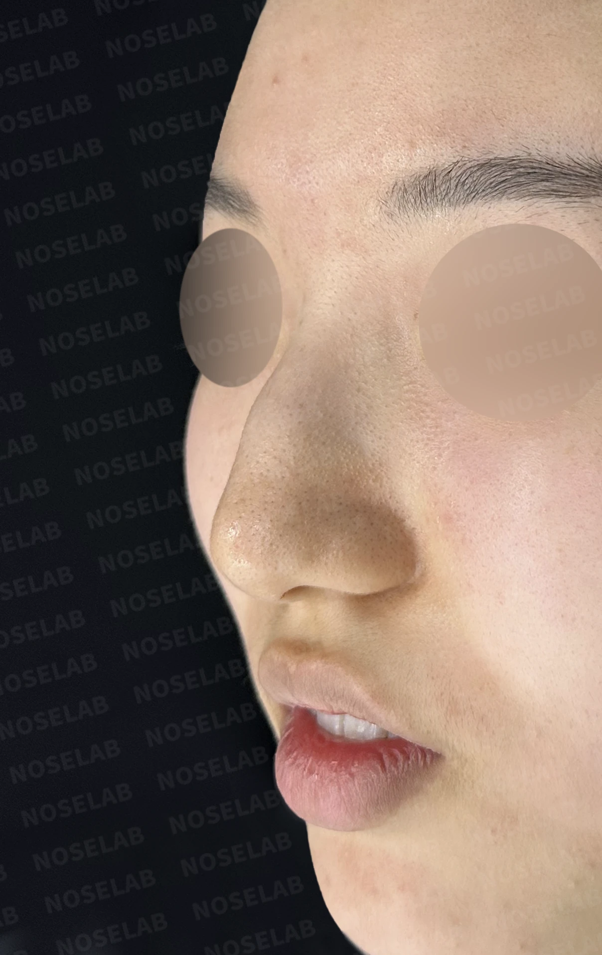 매부리코와 긴코 교정, 자가늑연골로 오똑한 코끝과 코막힘까지 해결 — 전(좌) 직후(후)