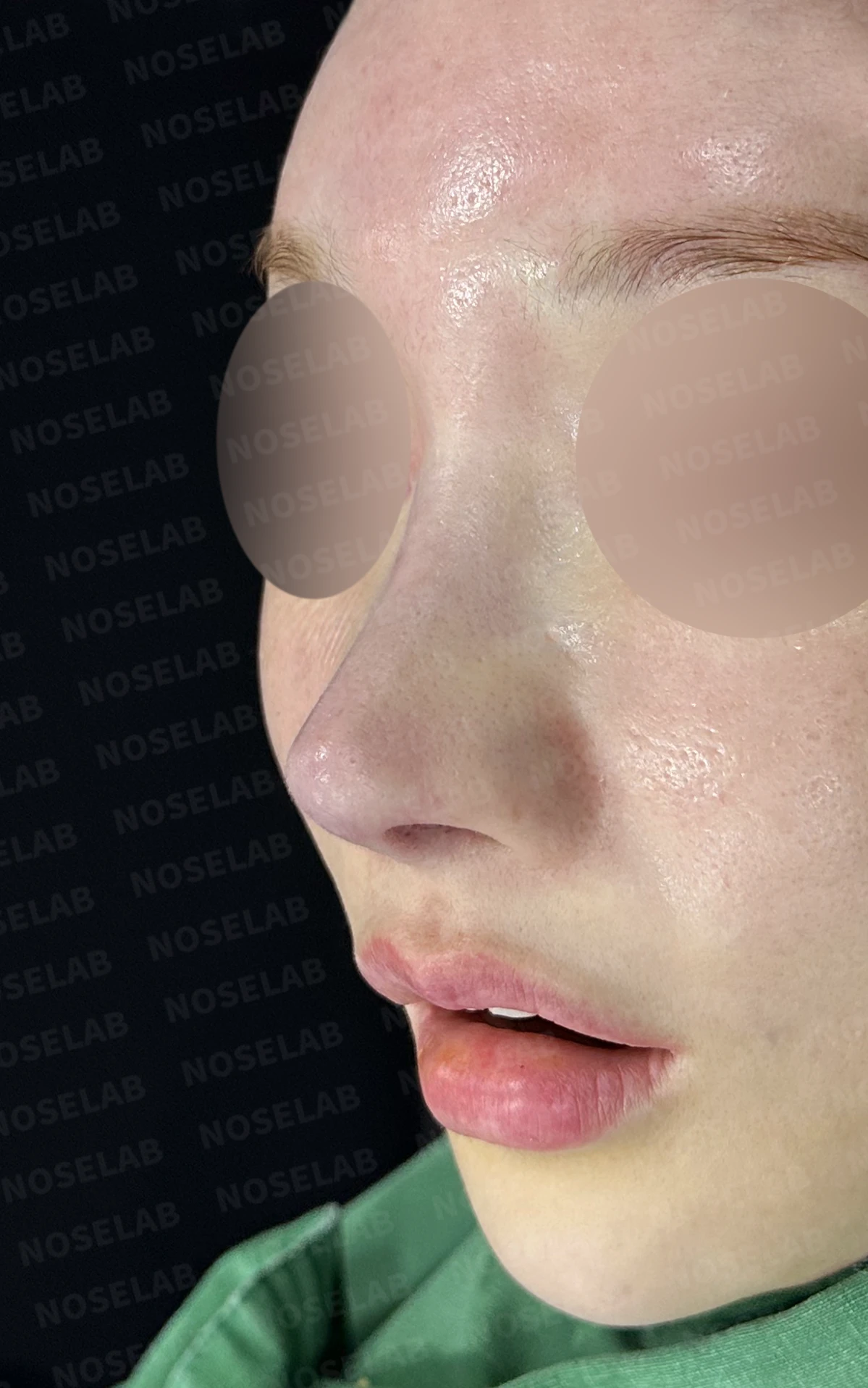 여러 차례 코수술 후 자가늑연골과 자가진피로 코 전체를 자연스럽게 높인 재수술 — 수술직후 정면, 비스듬한 측면, 측면 사진입니다.