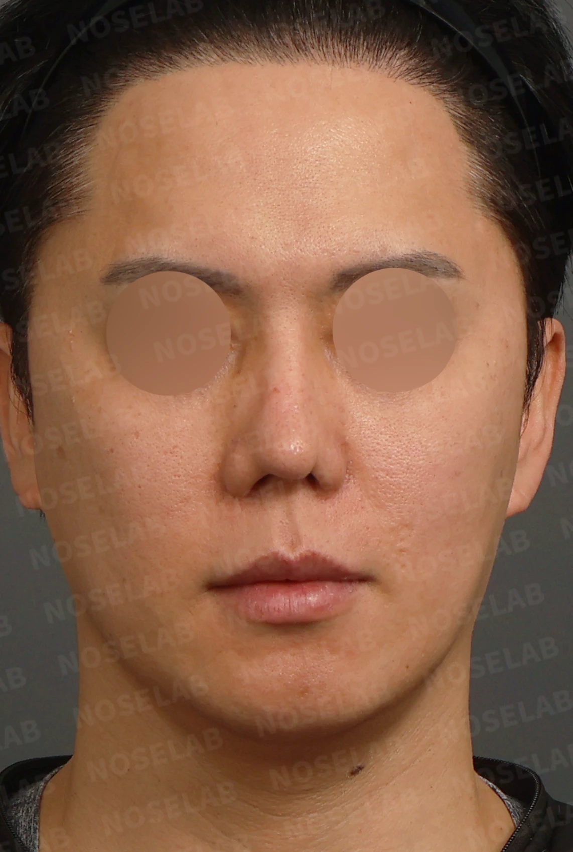여러 차례 코재수술 후 구축 변형, 자가늑연골로 재건한 사례 — 디자인 상담 정면, 좌측 측면, 비스듬한 측면 사진입니다.