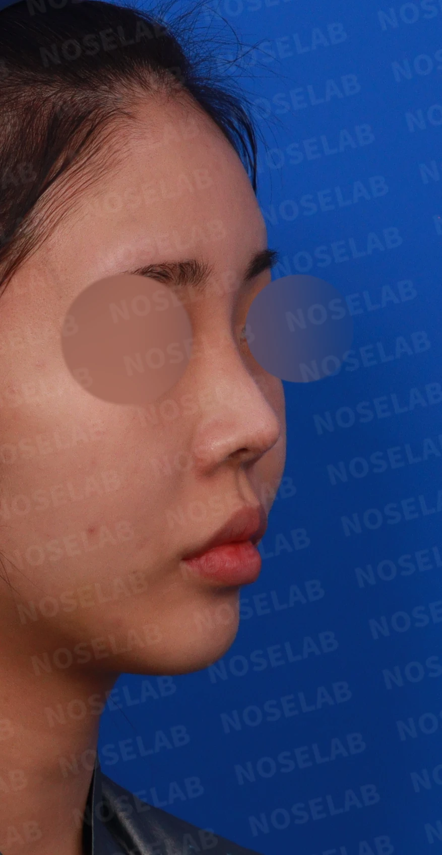 적절하지 않은 L자 실리콘 개선 - 안전한 구조로 재건 후기 — 디자인 상담 우측 비스듬한 측면, 측면, 비공 사진