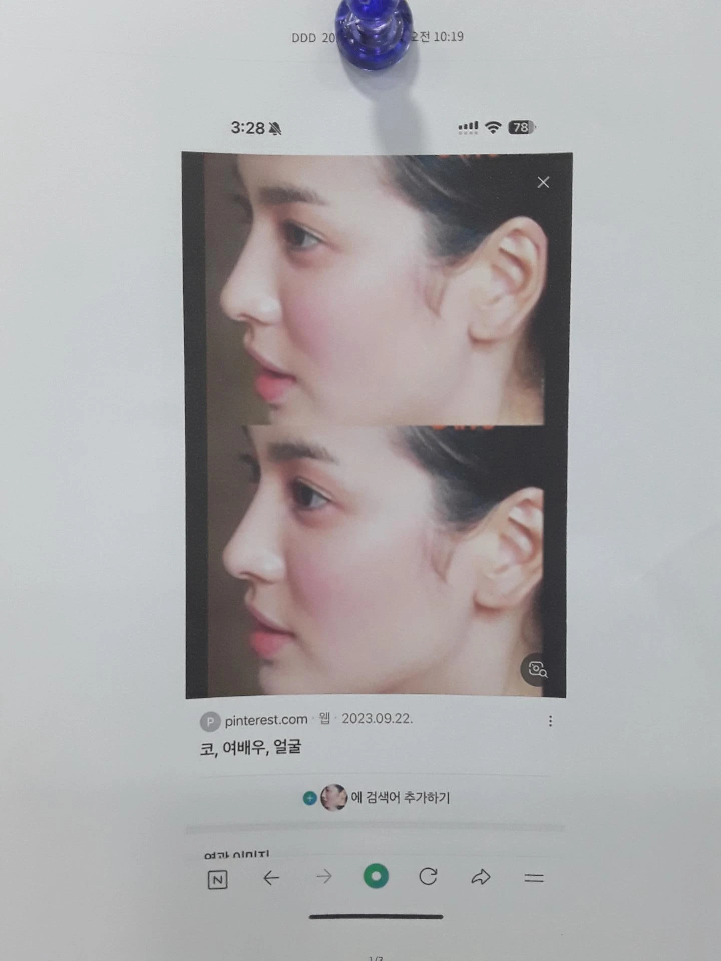 14년간 7차례 수술 후 비중격천공과 복잡한 코끝 문제 해결 - 자가늑연골 재건 실제 후기 — 환자분의 원하는 이미지