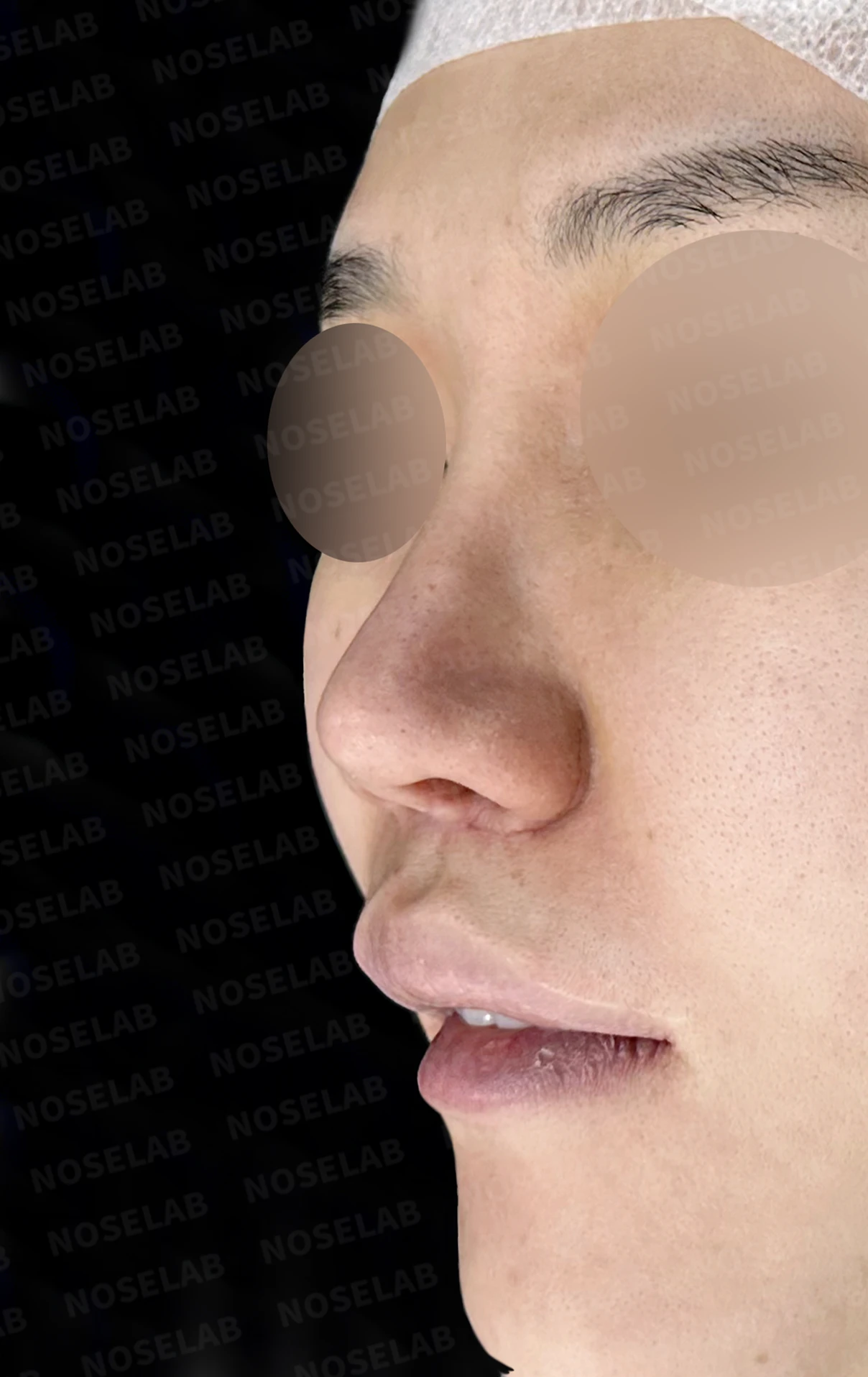 콧구멍 좌우가 심하게 달라 보이는 이유, 연골 재건과 피부이식 교정은 어떻게 하나 — 수술 전 / 수술 직후 0일 직후 사진은 부기가 있는 상태로 최종 결과와 다를 수 있습니다.