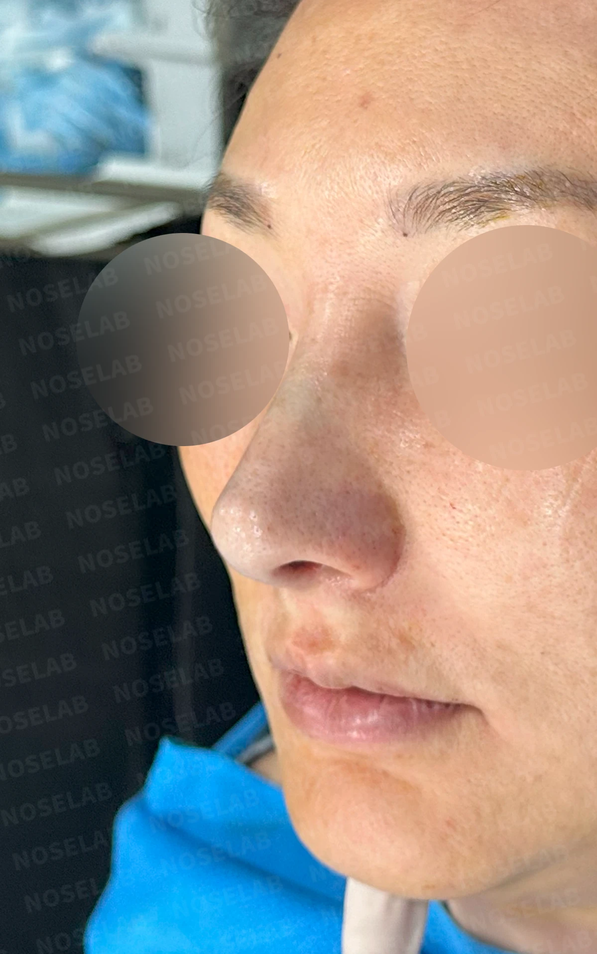매부리 교정을 받은 코가 다시 휘어 보이는 이유와 절골 재교정 방법 — 수술 직후 0일 정면, 측면, 비스듬한 측면 사진 직후 사진은 부기가 있는 상태로 최종 결과와 다를 수 있습니다.