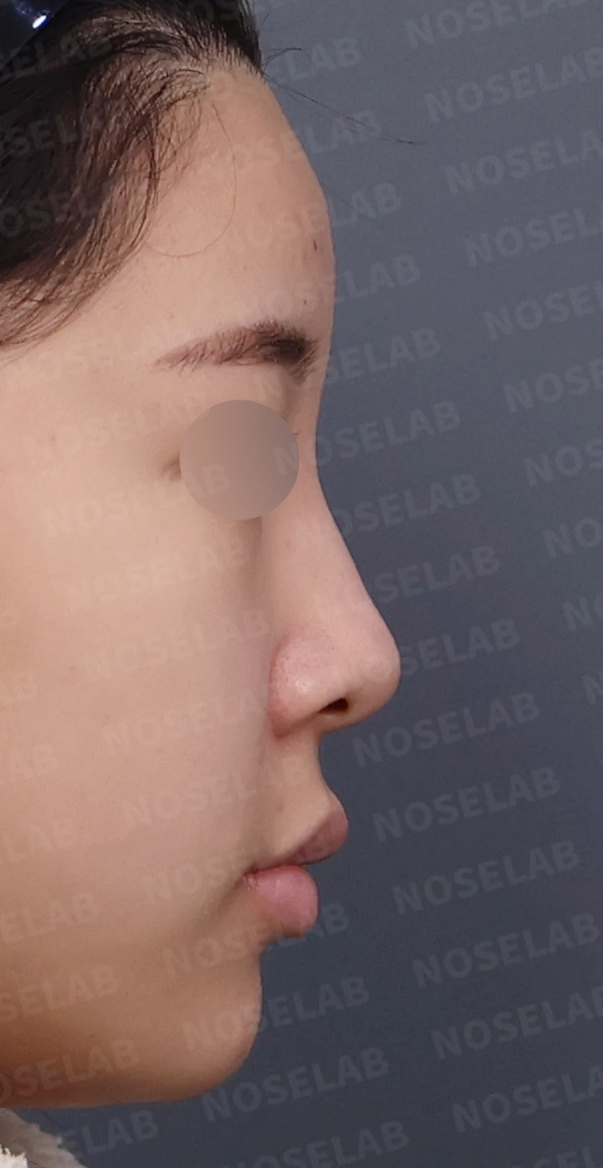 콧대가 넓고 단차져 보이는 이유, 절골술과 늑연골 코끝 성형은 어떻게 하나 — 디자인 상담 우측 측면, 비스듬한 측면, 비공 사진입니다.