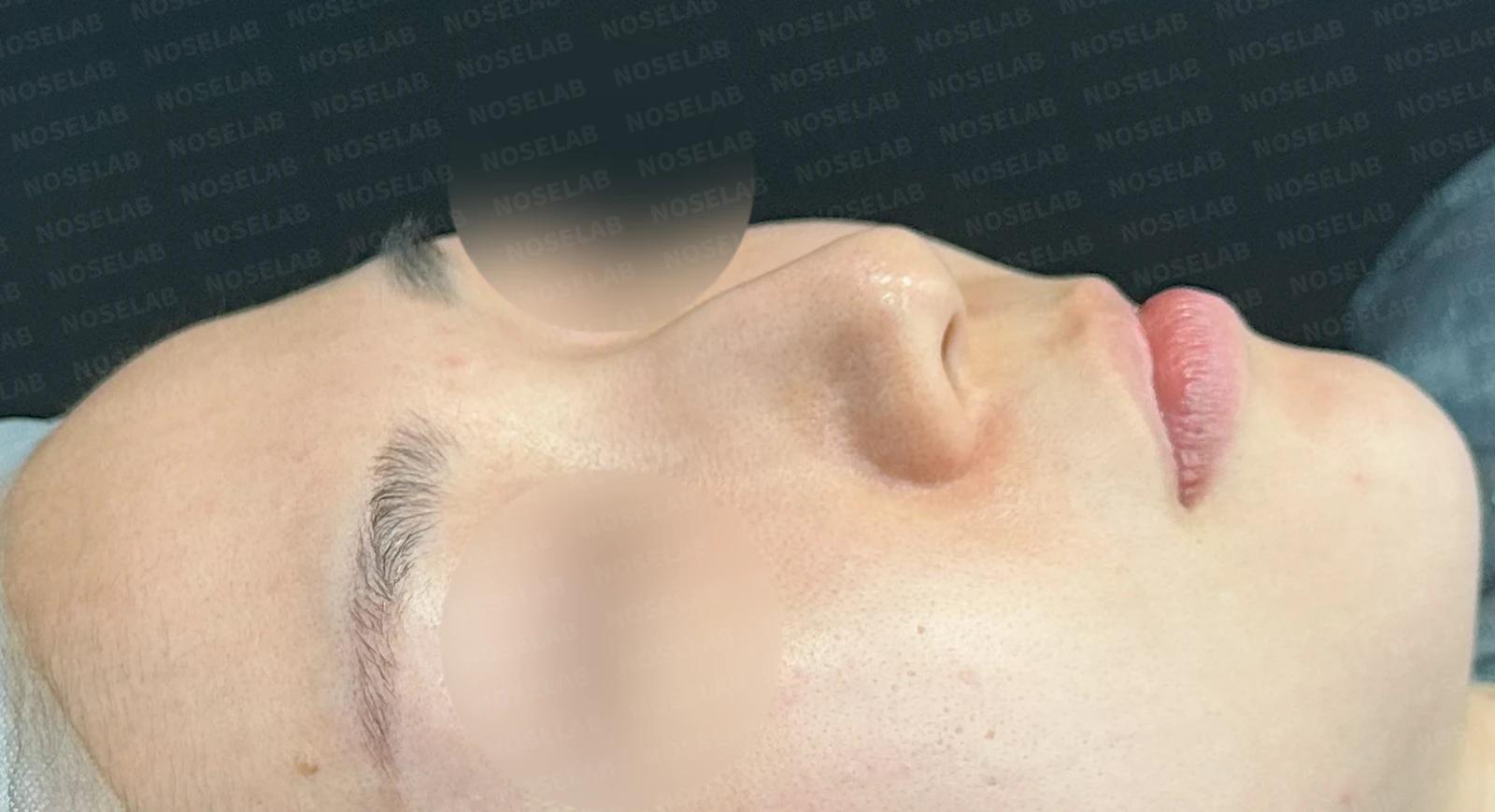 퍼진 코와 복코를 함께 교정하는 방법 — 수술 전 / 수술 직후 0일 직후 사진은 부기가 있는 상태로 최종 결과와 다를 수 있습니다.