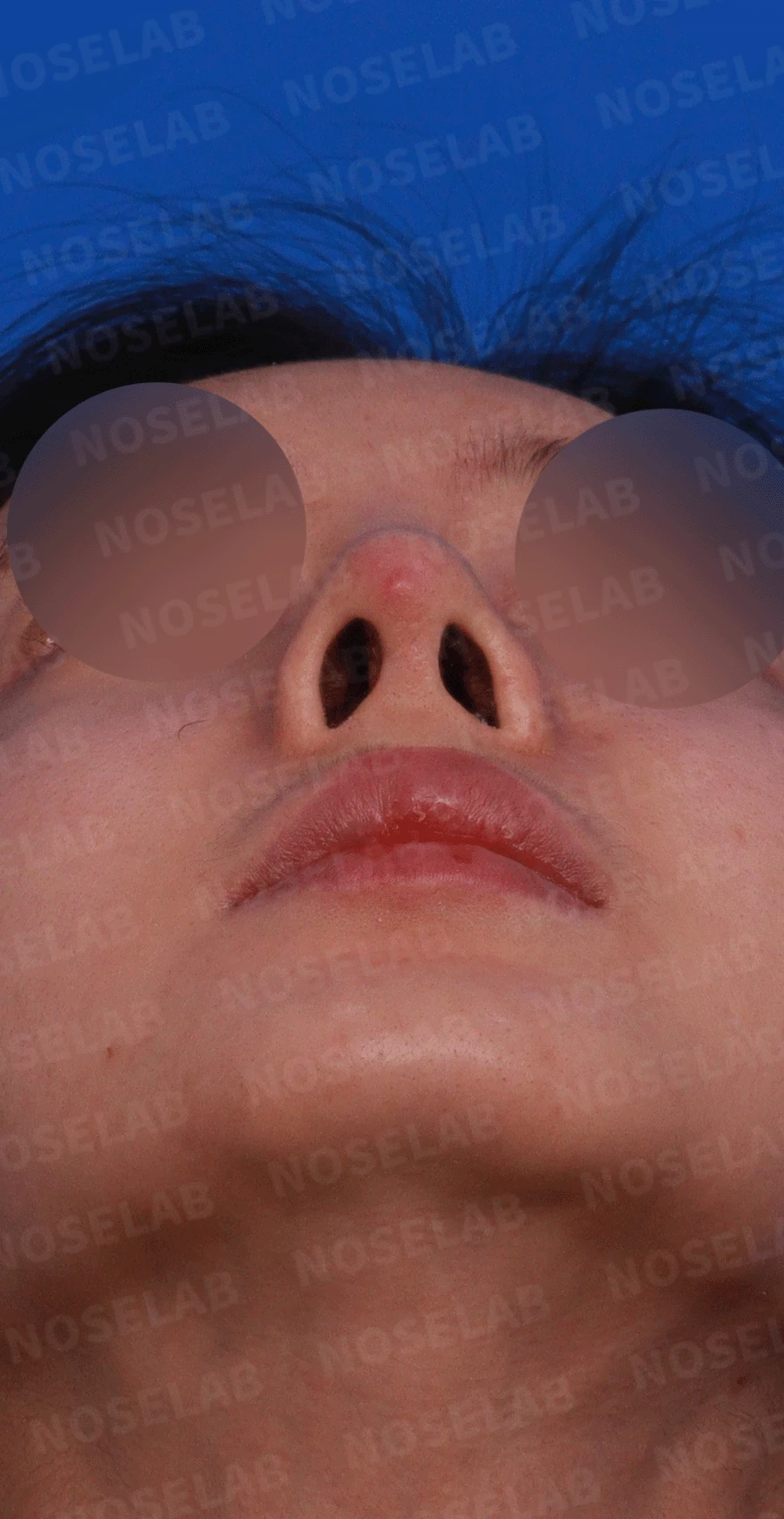 실리콘 보형물이 코끝 피부를 뚫고 나오려 할 때, 왜 생기고 어떻게 재건하나 — 디자인 상담 비공, 우측 측면, 비스듬한 측면 사진