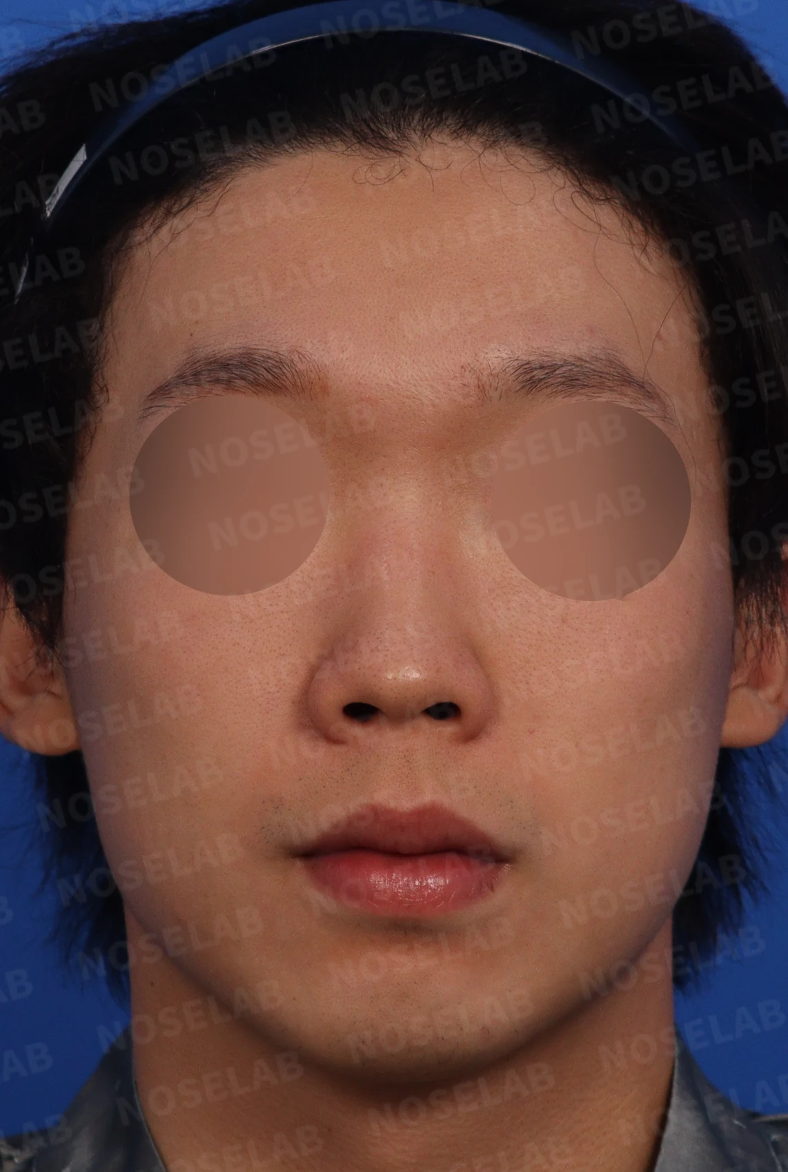 들린코, 작은코, 비순각 교정 사례 - 기능과 미용을 동시에 잡다 — 수술전 디자인 상담 정면, 좌측 비스듬한 측면, 측면 사진입니다.