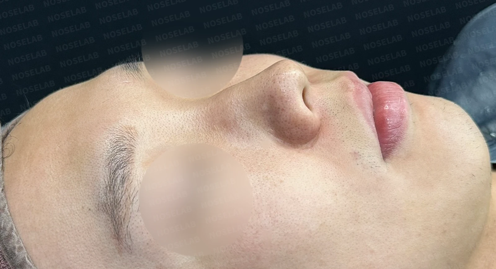 들린코, 작은코, 비순각 교정 사례 - 기능과 미용을 동시에 잡다 — 수술전(좌) 수술직후(우)