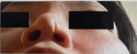 콧구멍을 막는 종괴가 생기는 이유, 제거와 재건은 어떻게 하나 — 본문 사진 6