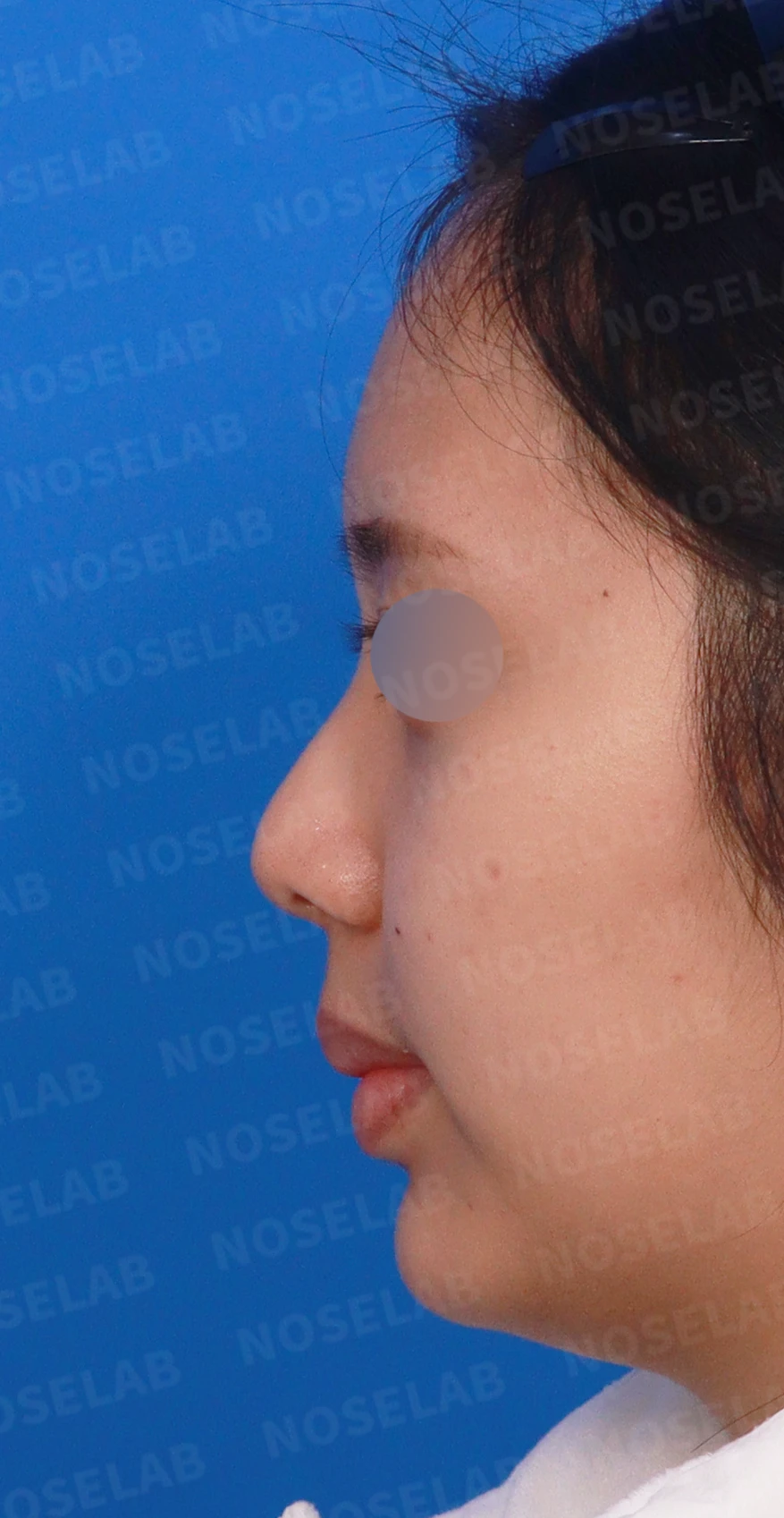 휘어진 매부리와 처진 코끝이 생기는 이유, 비중격 연장술은 어떻게 하나 — 디자인 상담 정면, 좌측 측면, 비스듬한 측면 사진입니다.