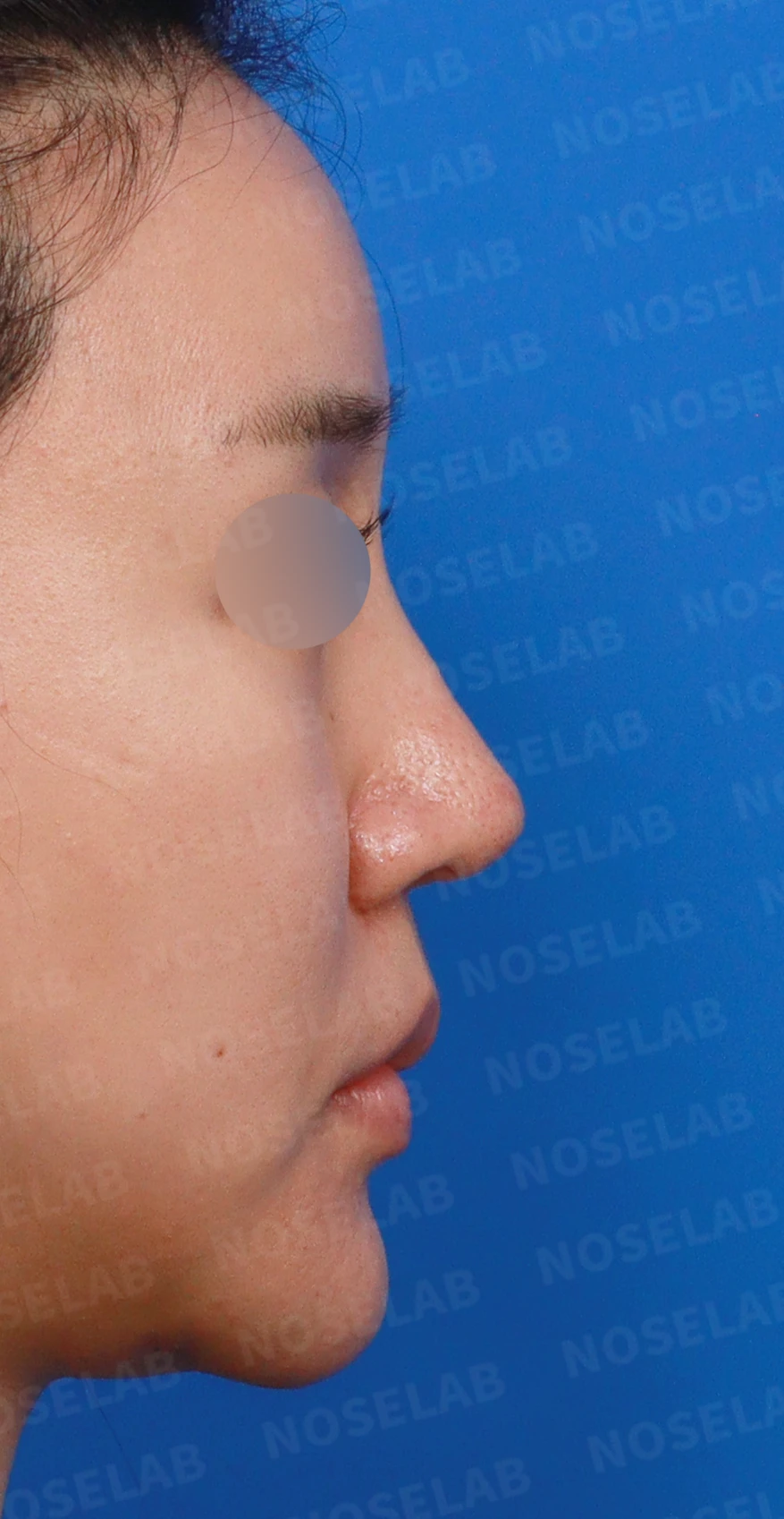 영구 필러가 코 모양을 바꾸는 과정과 제거 후 재건 방법 — 디자인 상담 우측 측면, 비스듬한 측면, 비공 사진입니다.