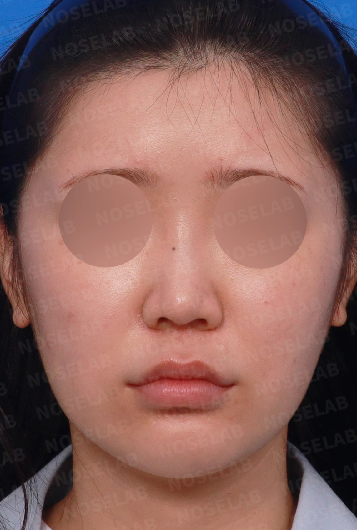 연골 노출 복원과 날개 연골 재건으로 안전하고 자연스러운 코 — 디자인 상담 정면, 좌측 측면, 비스듬한 측면 사진입니다.