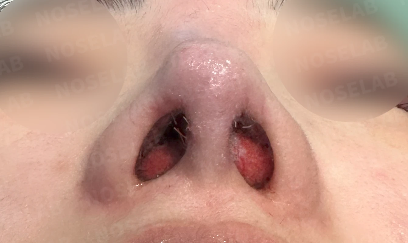 퍼진 코 개선과 콧구멍 비대칭 교정 방법 — 본문 사진 16