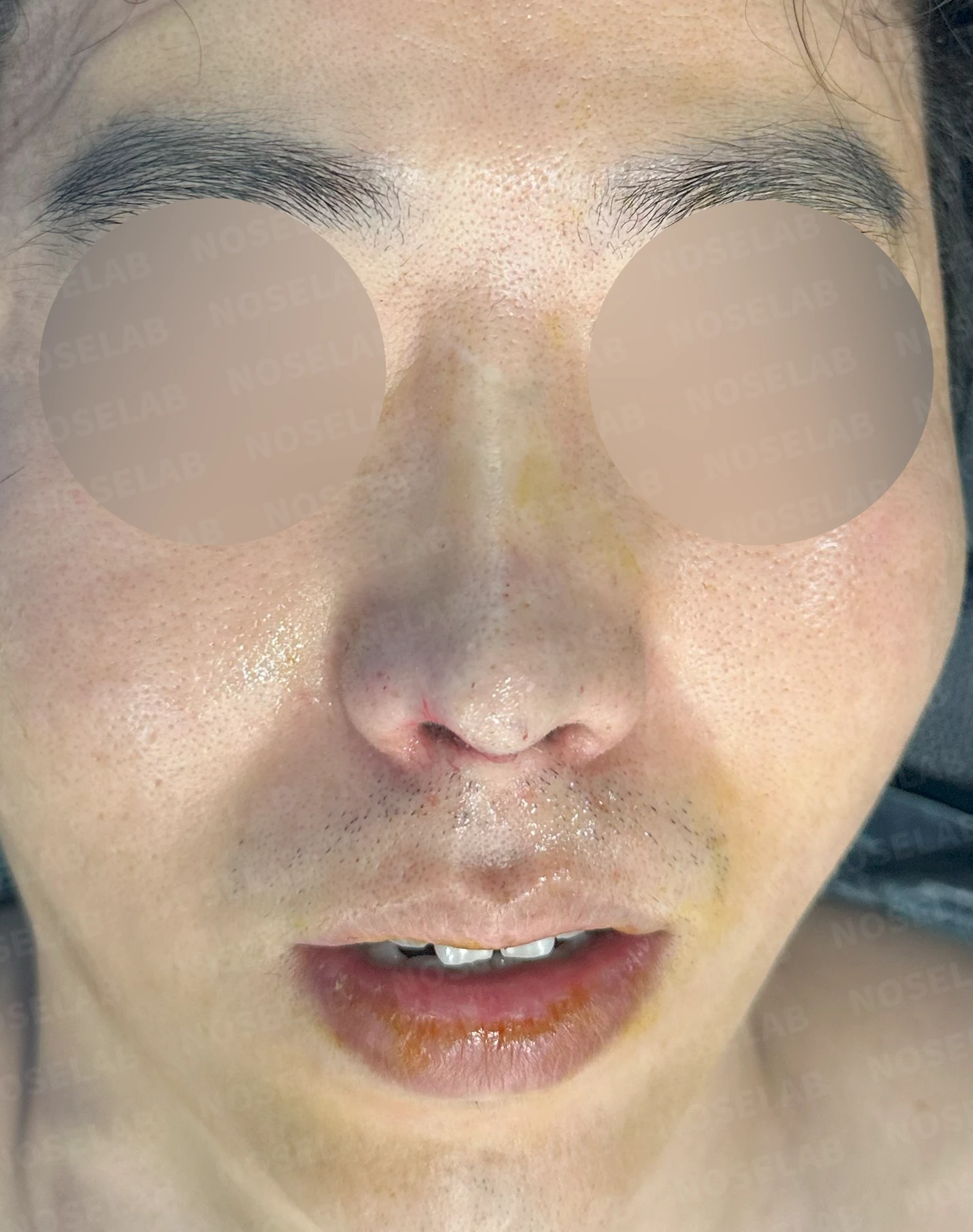 코끝 염증을 겪은 뒤 콧날개가 찝히고 코끝이 꺼지는 이유와 재건 방법 — 수술 직후 0일 정면, 측면, 비스듬한 측면 사진 직후 사진은 부기가 있는 상태로 최종 결과와 다를 수 있습니다.