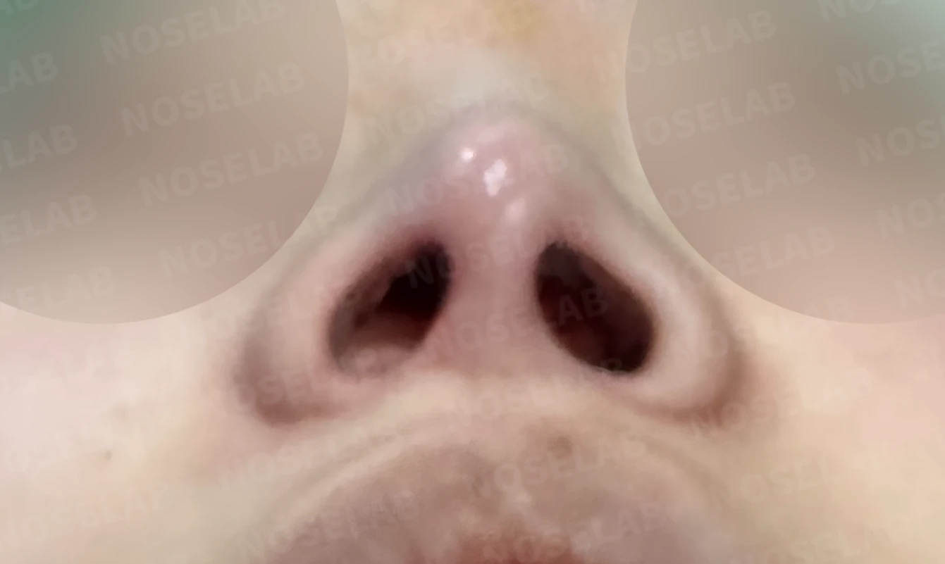 코가 퍼지고 코끝이 뭉툭해 보이는 이유, 비중격연골과 귀연골 교정은 어떻게 하나 — 수술 직후 0일 비공 사진입니다. 직후 사진은 부기가 있는 상태로 최종 결과와 다를 수 있습니다.