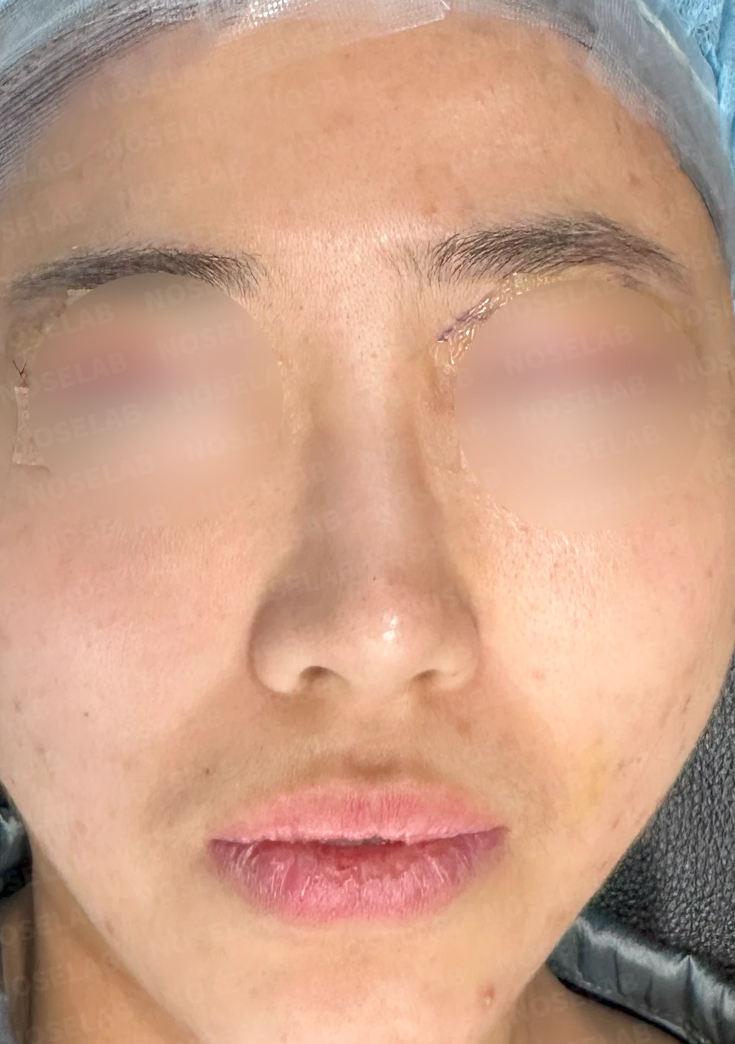 코필러 제거, 코막힘 해결 사례 — 전(좌) 직후(우)