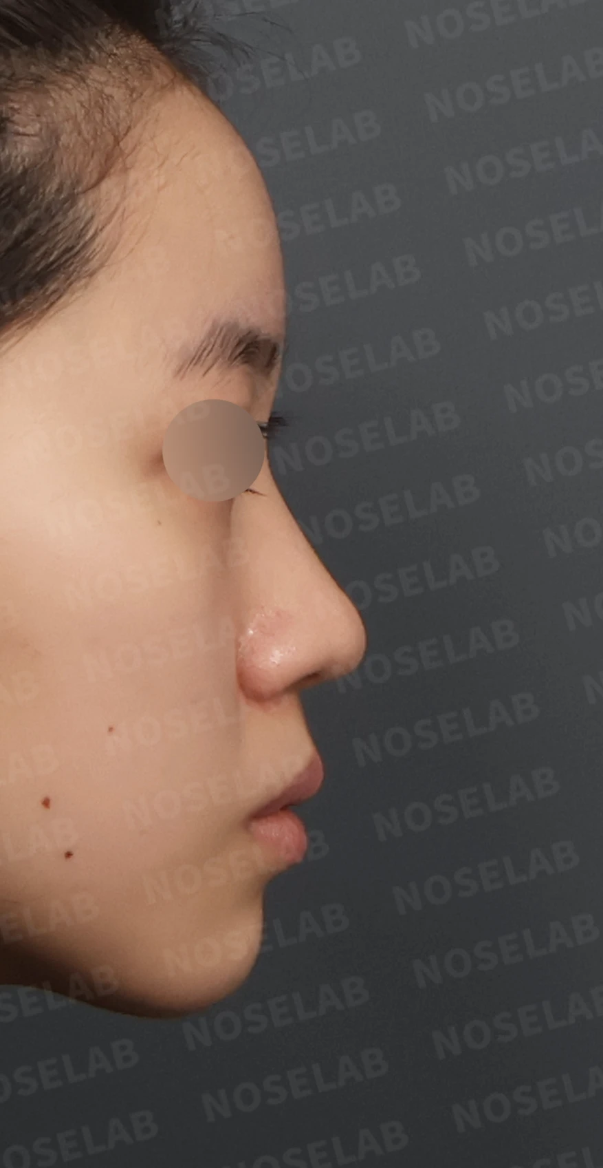 복코와 주먹코, 자가늑연골로 얄쌍하고 여성스러운 코 완성 — 디자인 상담 우측 측면, 비스듬한 측면, 비공 사진입니다.