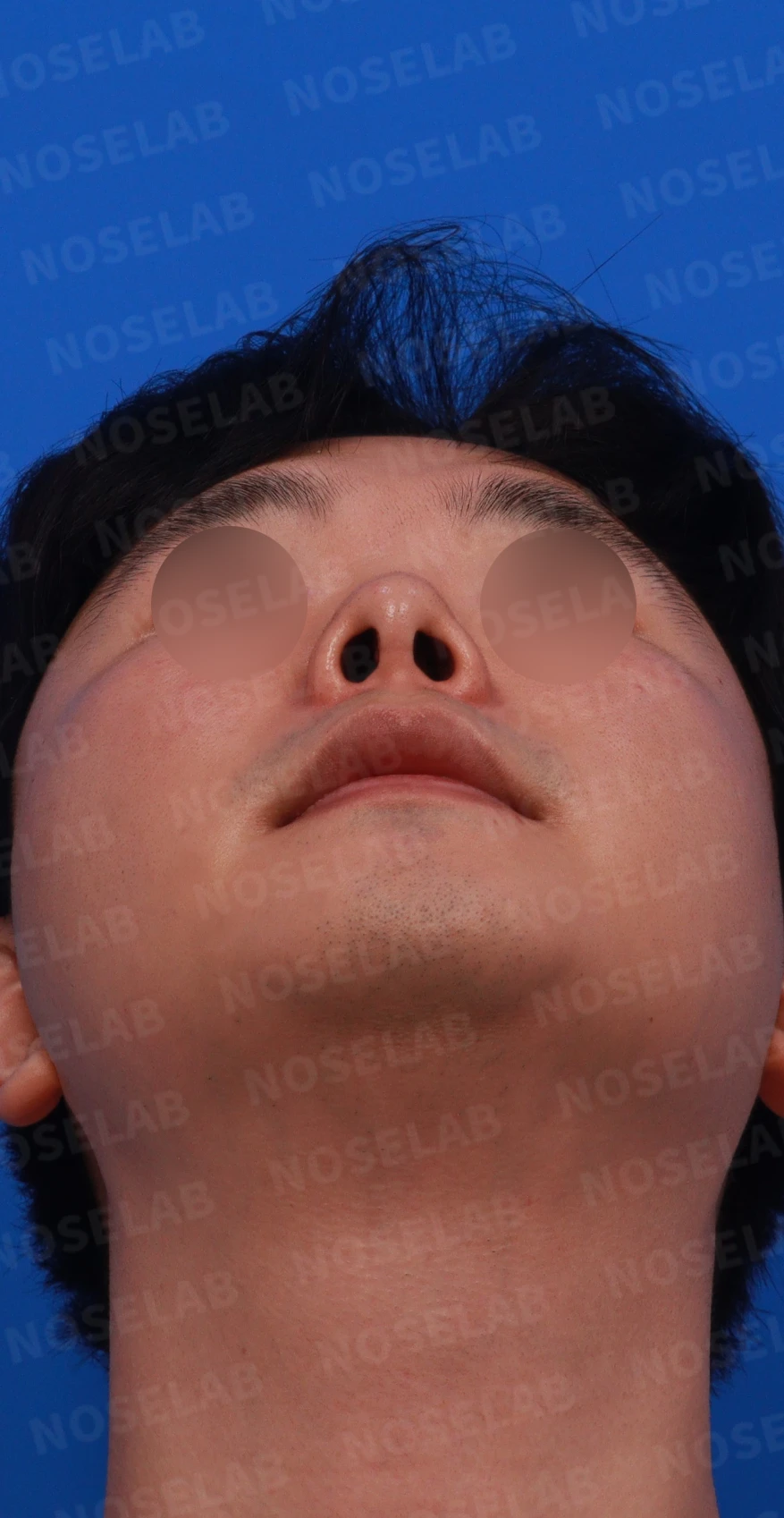 비중격 연골을 많이 쓴 코가 들리고 막히는 이유, 재건은 어떻게 하나 — 디자인 상담 우측 측면 , 비스듬한 측면 , 비공 사진입니다.