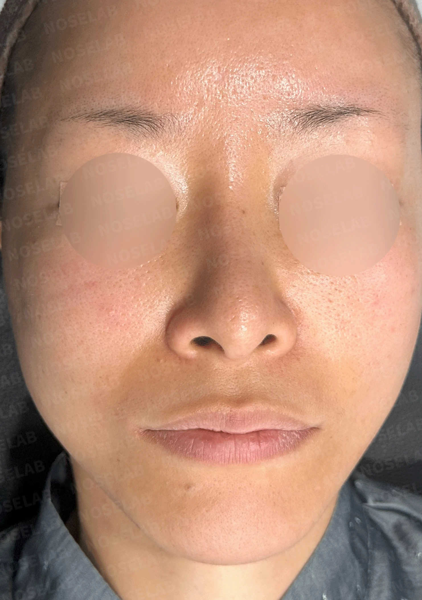후비루와 코끝 처짐이 함께 나타나는 이유, 비중격 연장과 기능 수술은 어떻게 하나 — 본문 사진 7