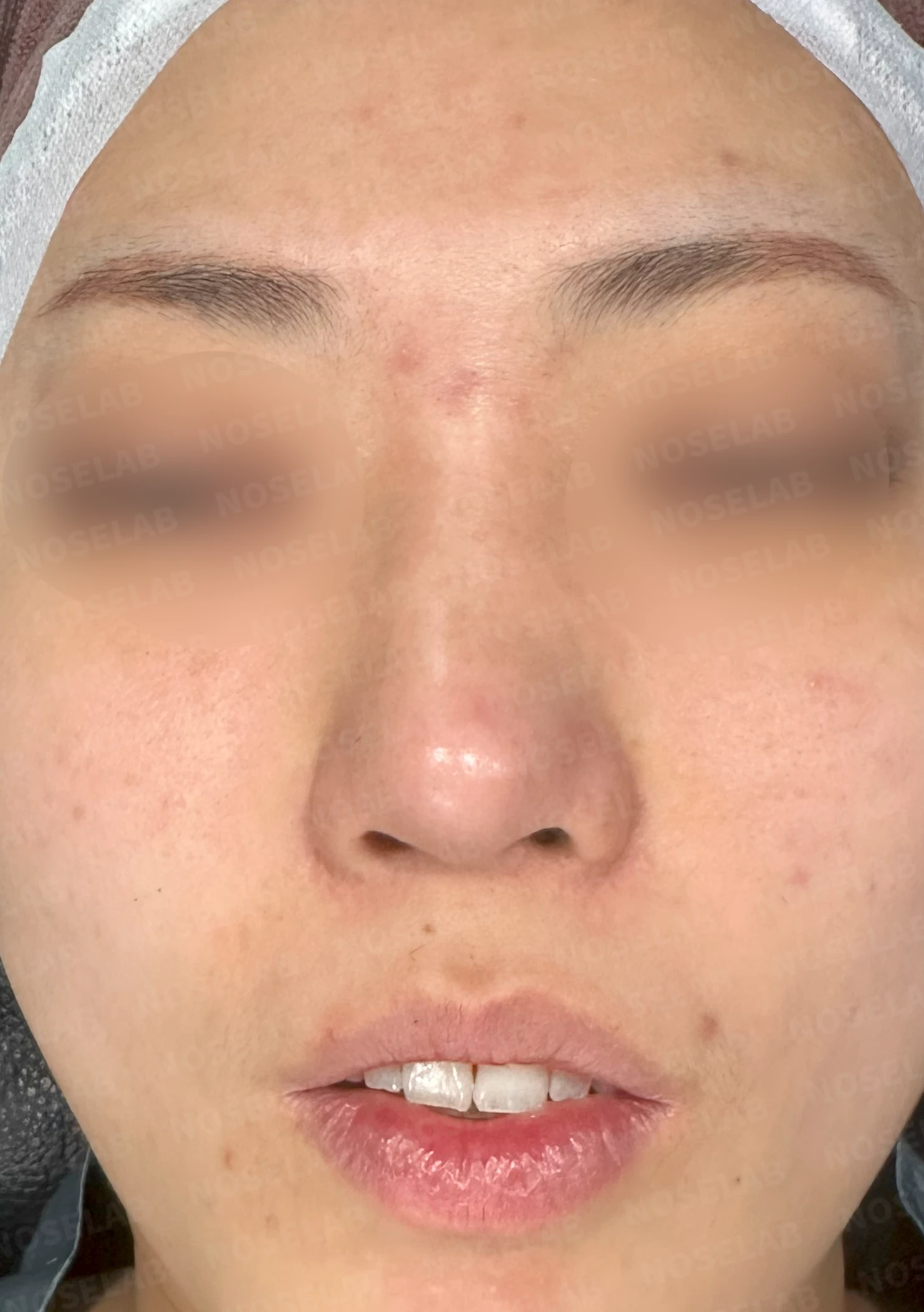 휘어진 코 교정과 비염 개선 - 자가늑연골 재건술 후기 — 전(좌) 직후(우)